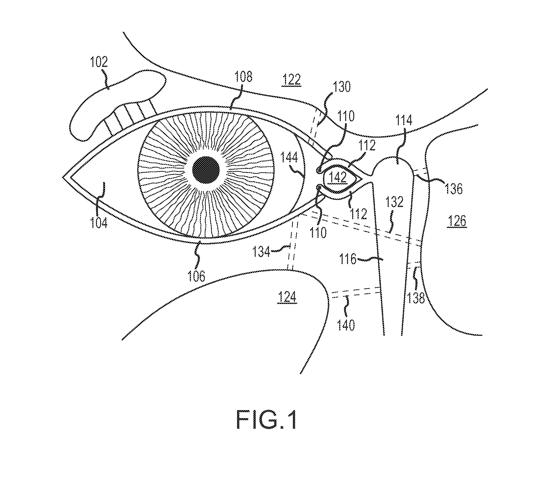 Paranasal sinus access implant devices and related tools, methods and kits