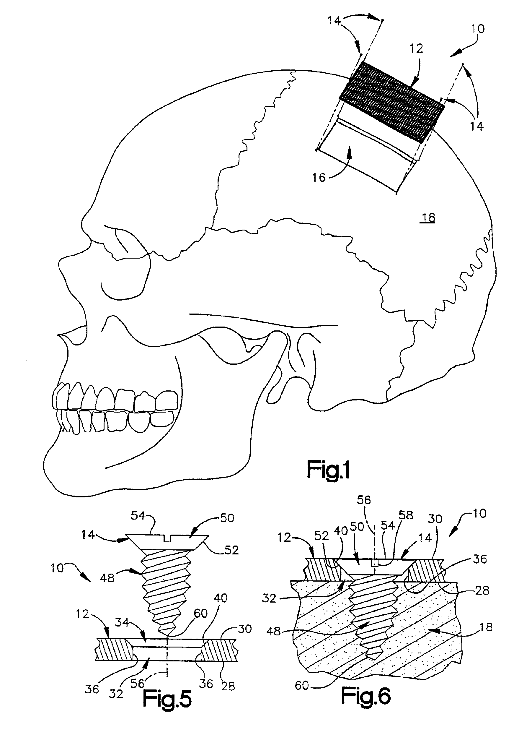 Implantable device for covering and opening in a cranium