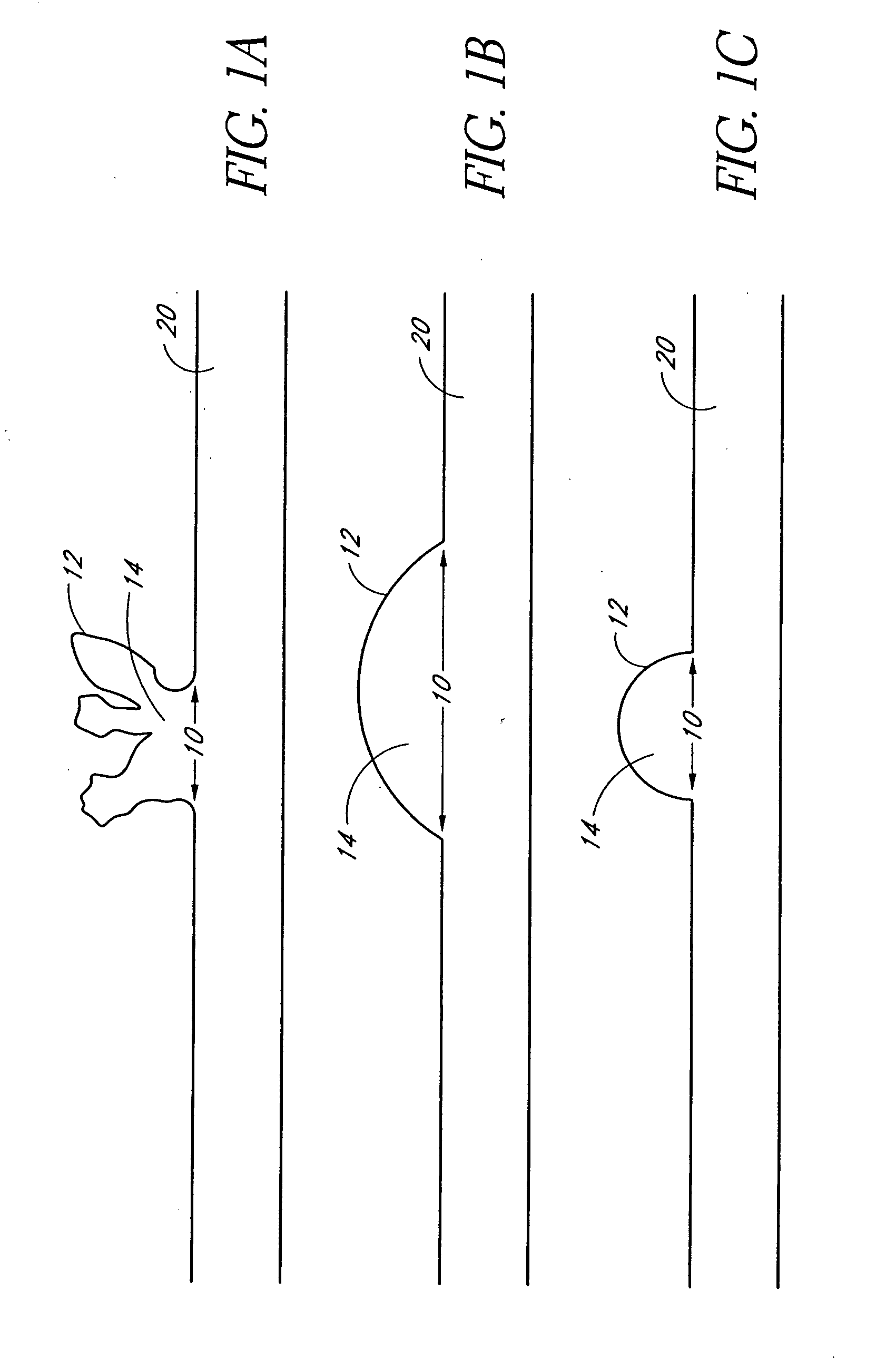 Dynamically adjustable vascular stent