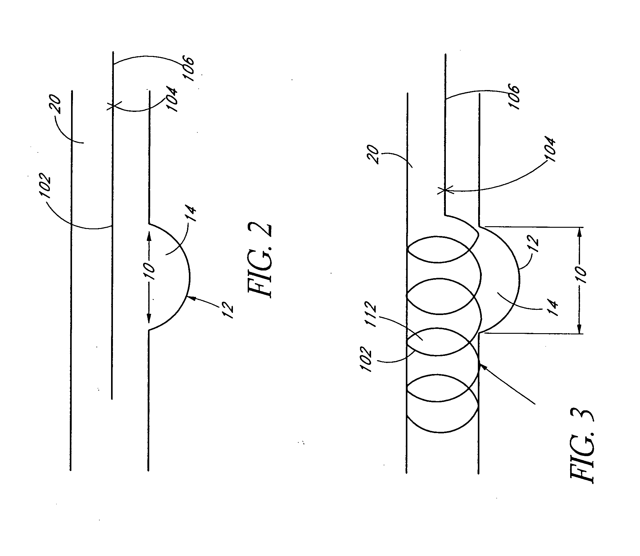 Dynamically adjustable vascular stent