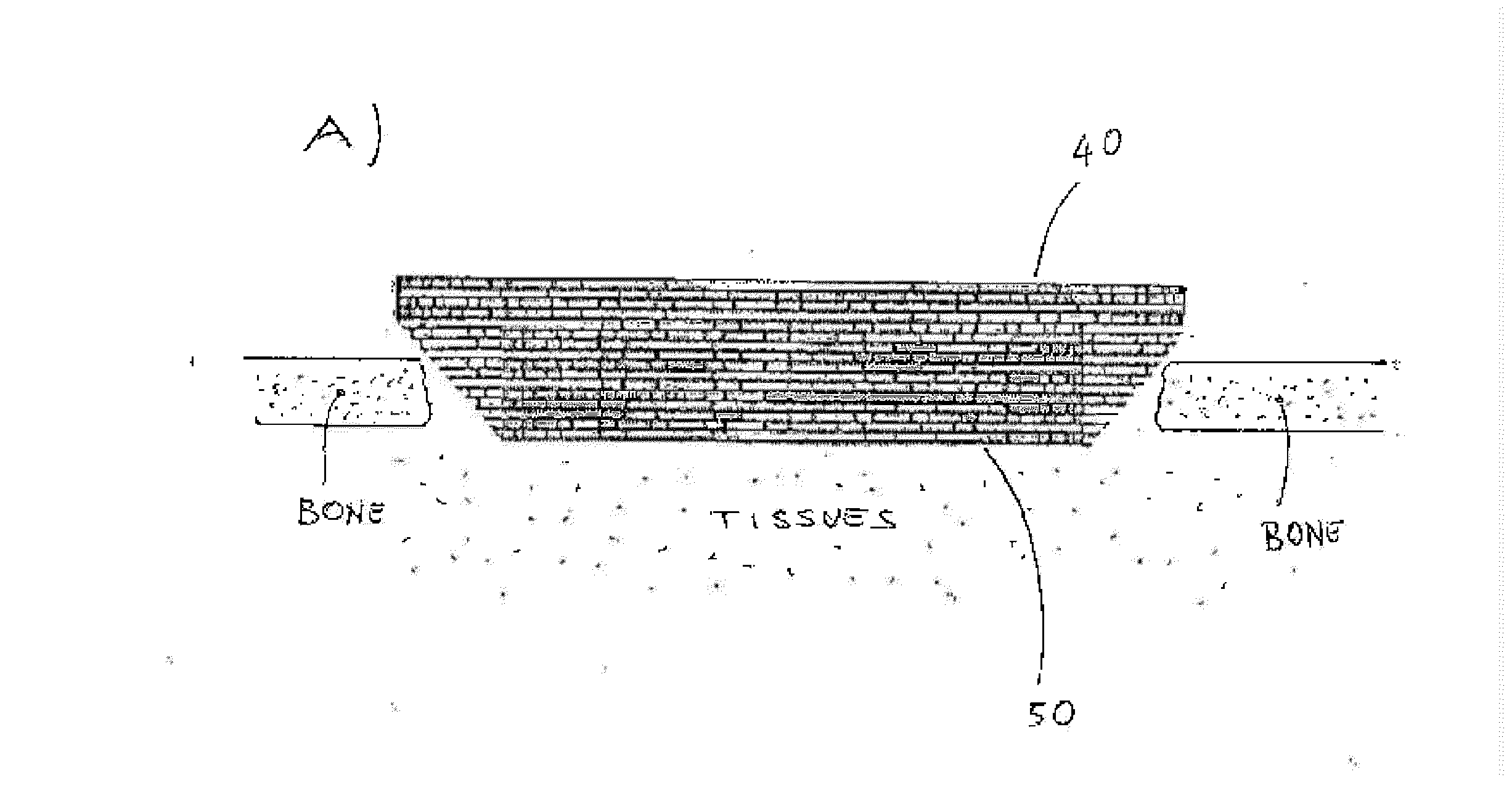 Bioabsorbable plug implants and method for bone tissue regeneration