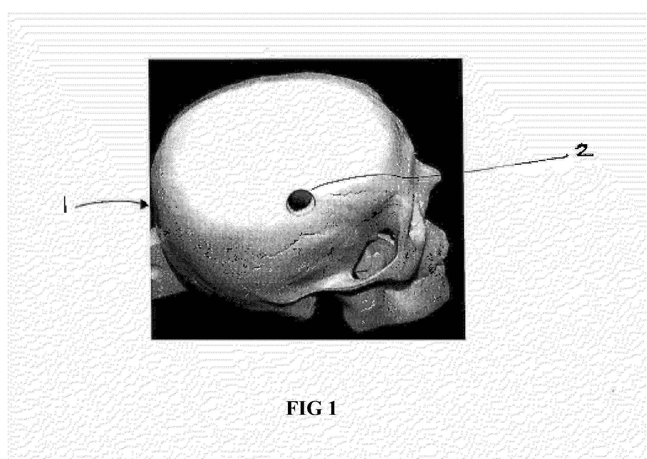 Bioabsorbable plug implants and method for bone tissue regeneration