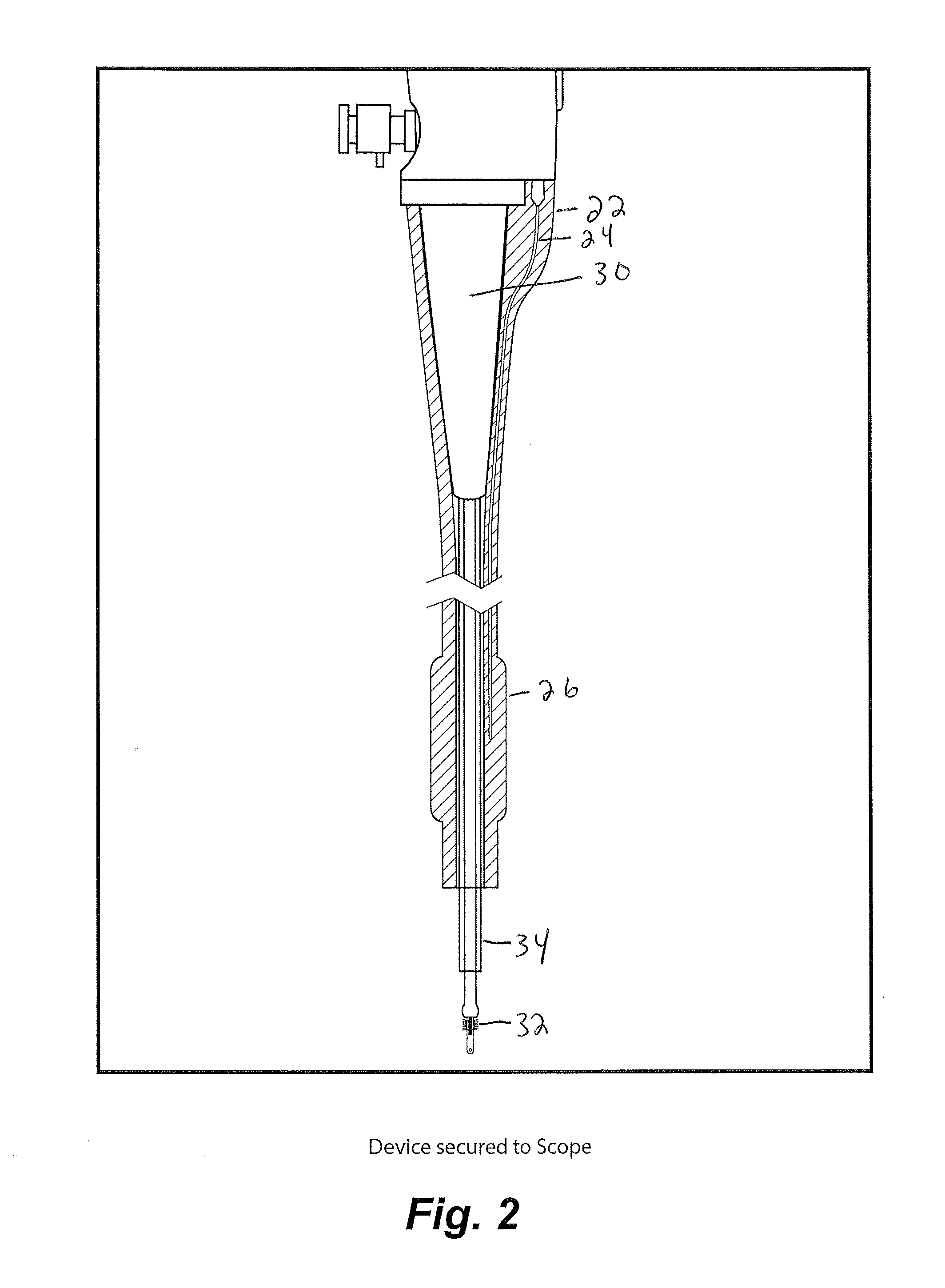 Apparatus and method for ovarian cancer screening