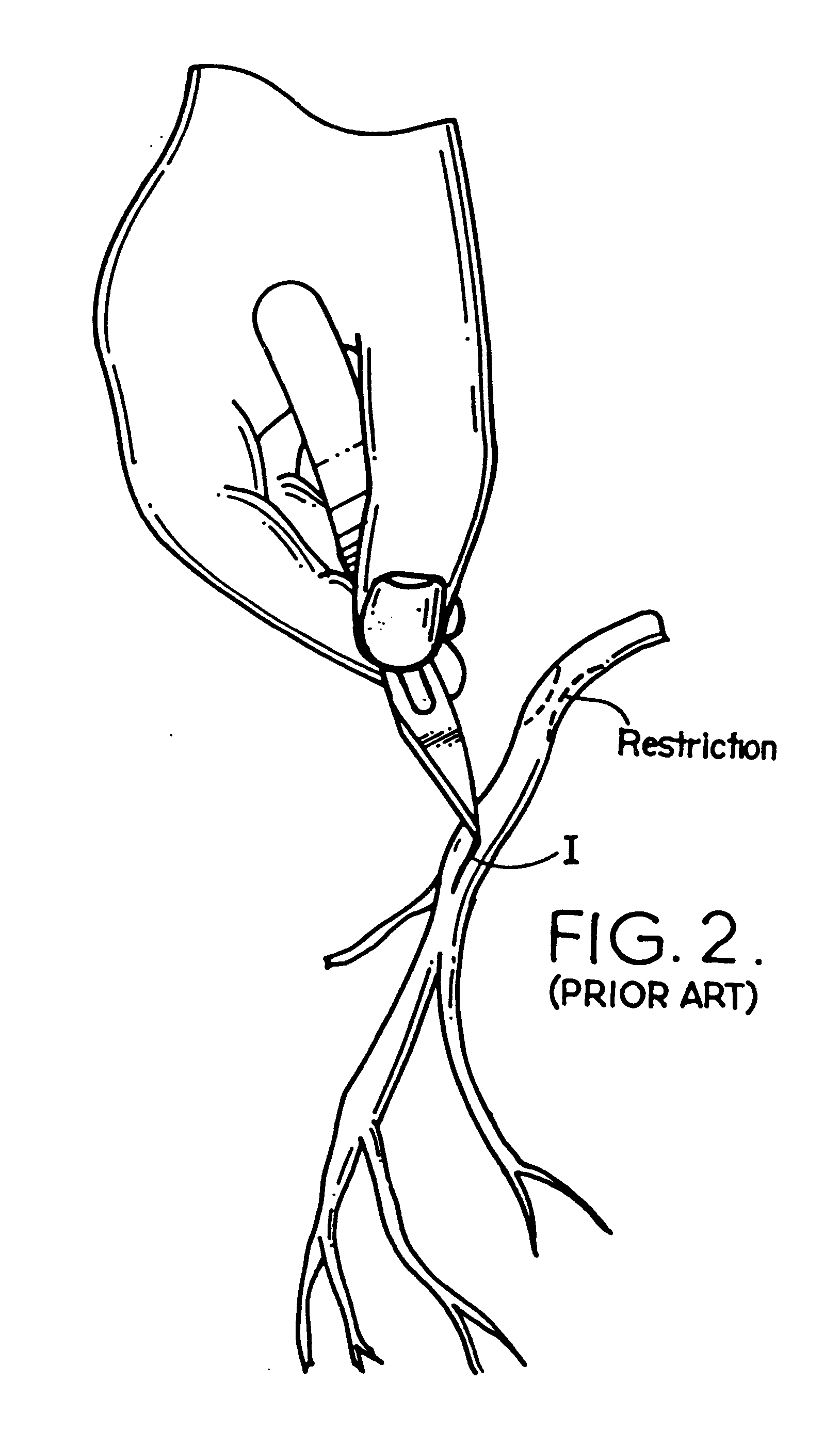 Means and method for performing an anastomosis