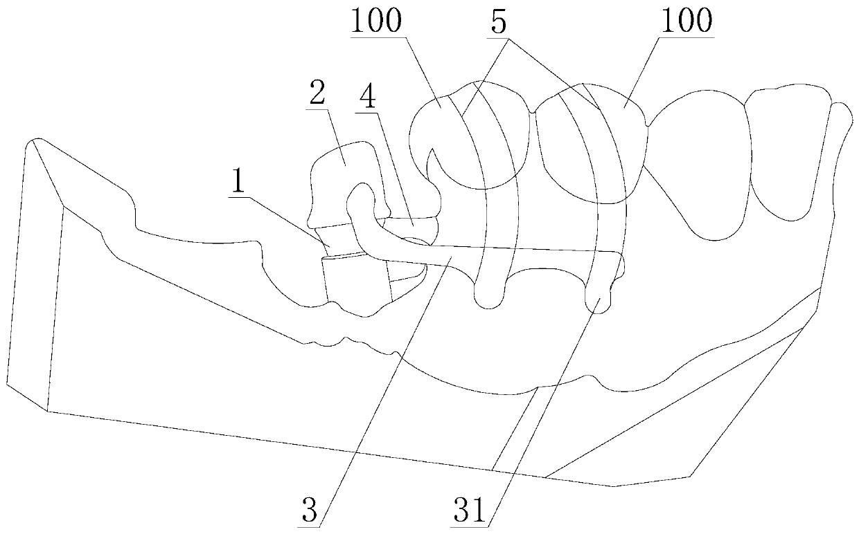 Mandibular posterior tooth lowering device