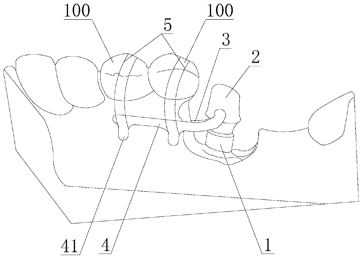 Mandibular posterior tooth lowering device