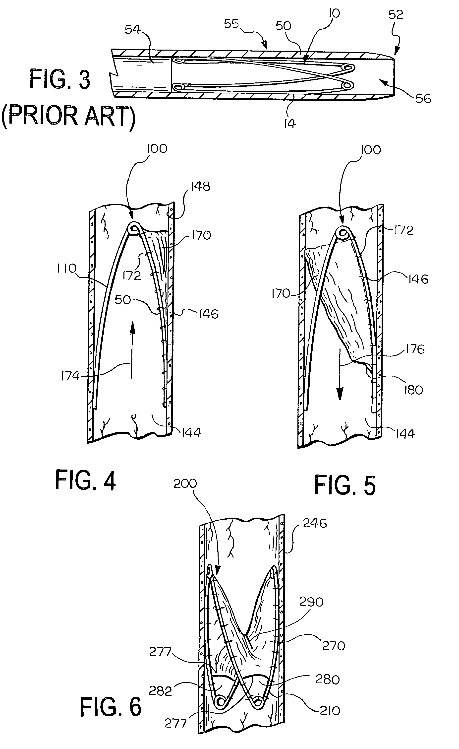 Prosthetic valve that permits retrograde flow