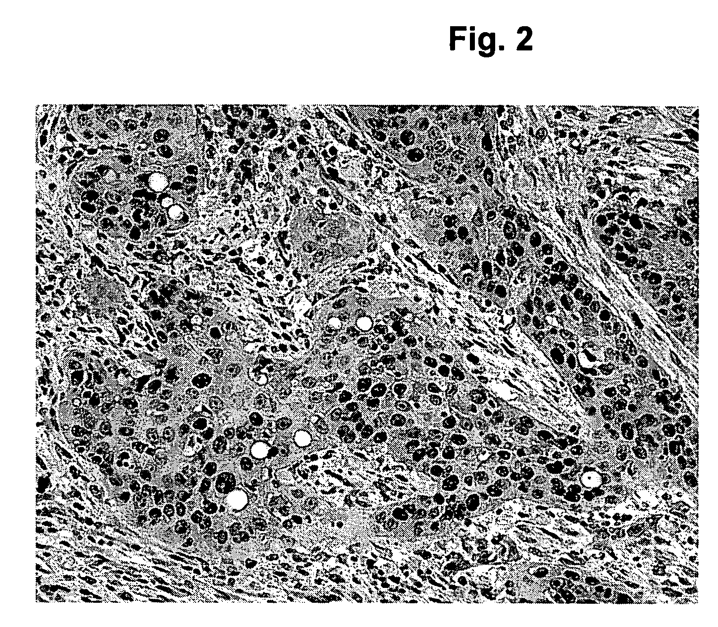 Method of pre-sensitizing cancer prior to treament with radiation and/or chemotherapy and a novel cytokine mixture