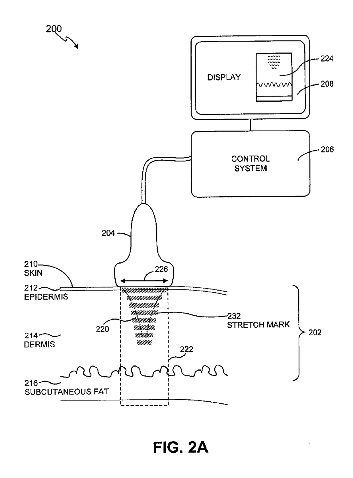 Method and system for ultrasound treatment of skin