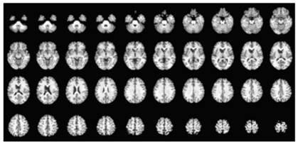 Automatic rapid visualization method for resting state brain function connection