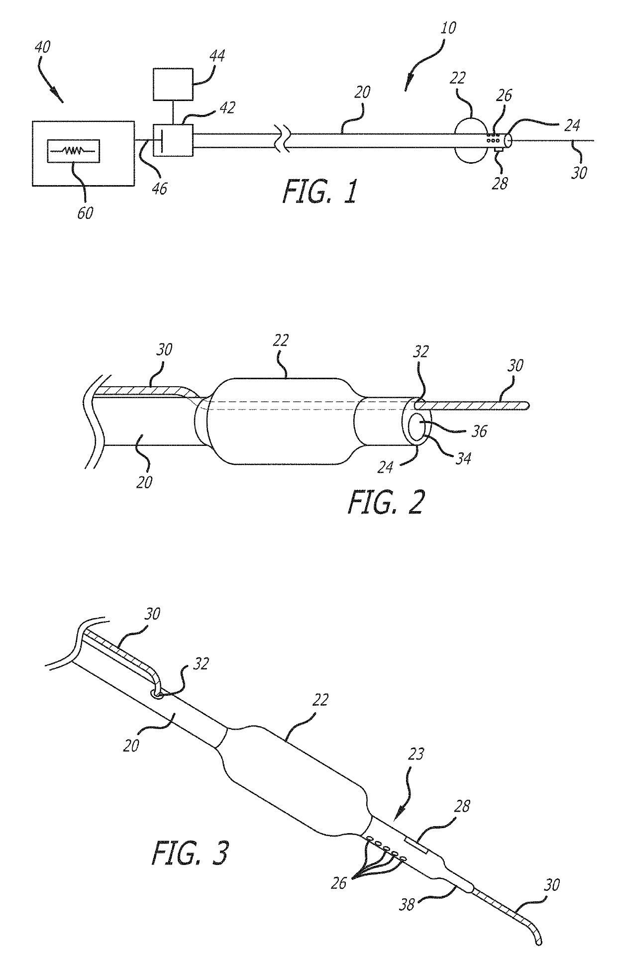 System and methods for treating MVO