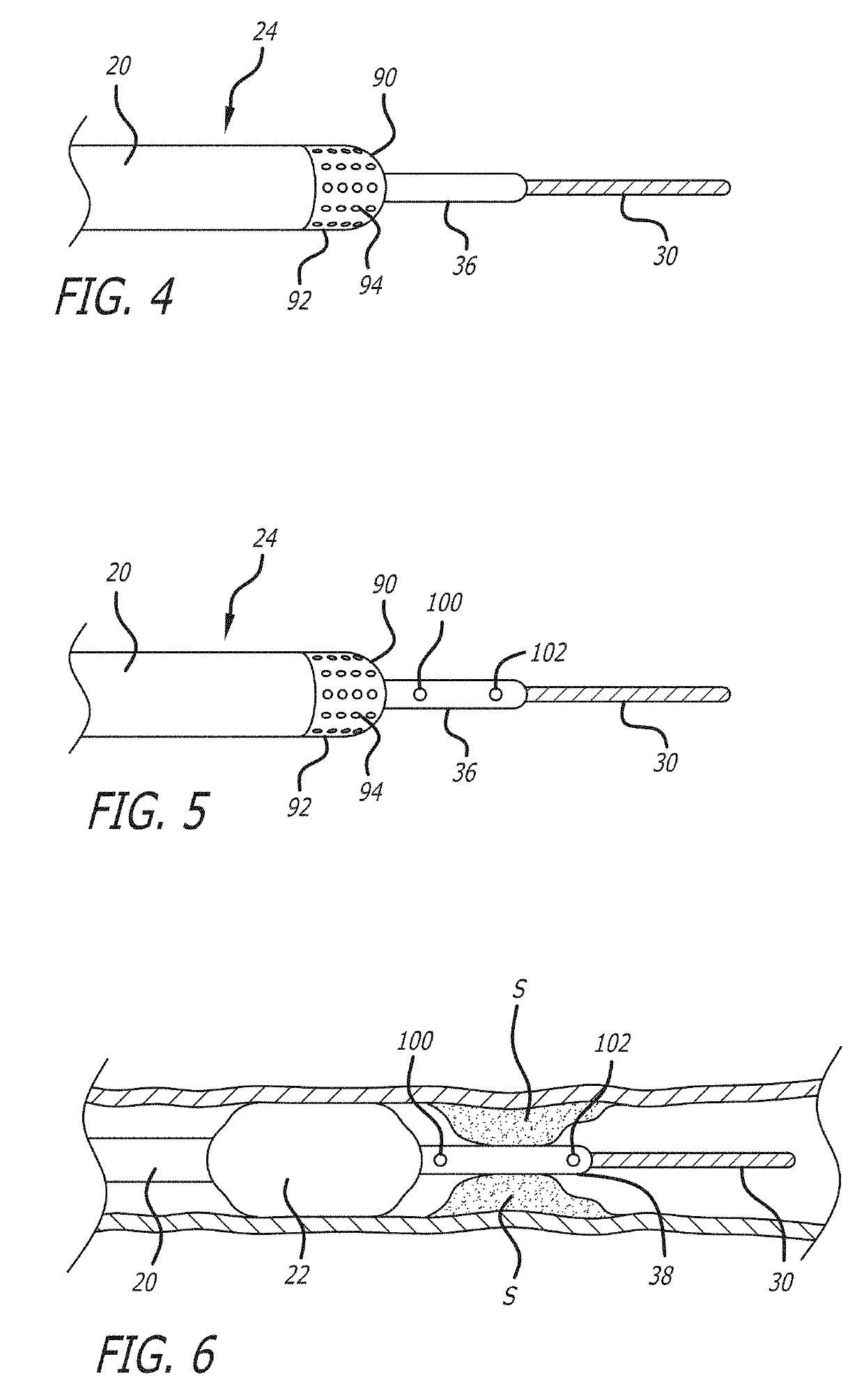 System and methods for treating MVO