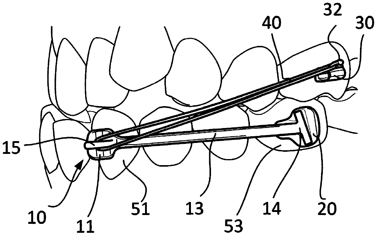 An orthodontic device