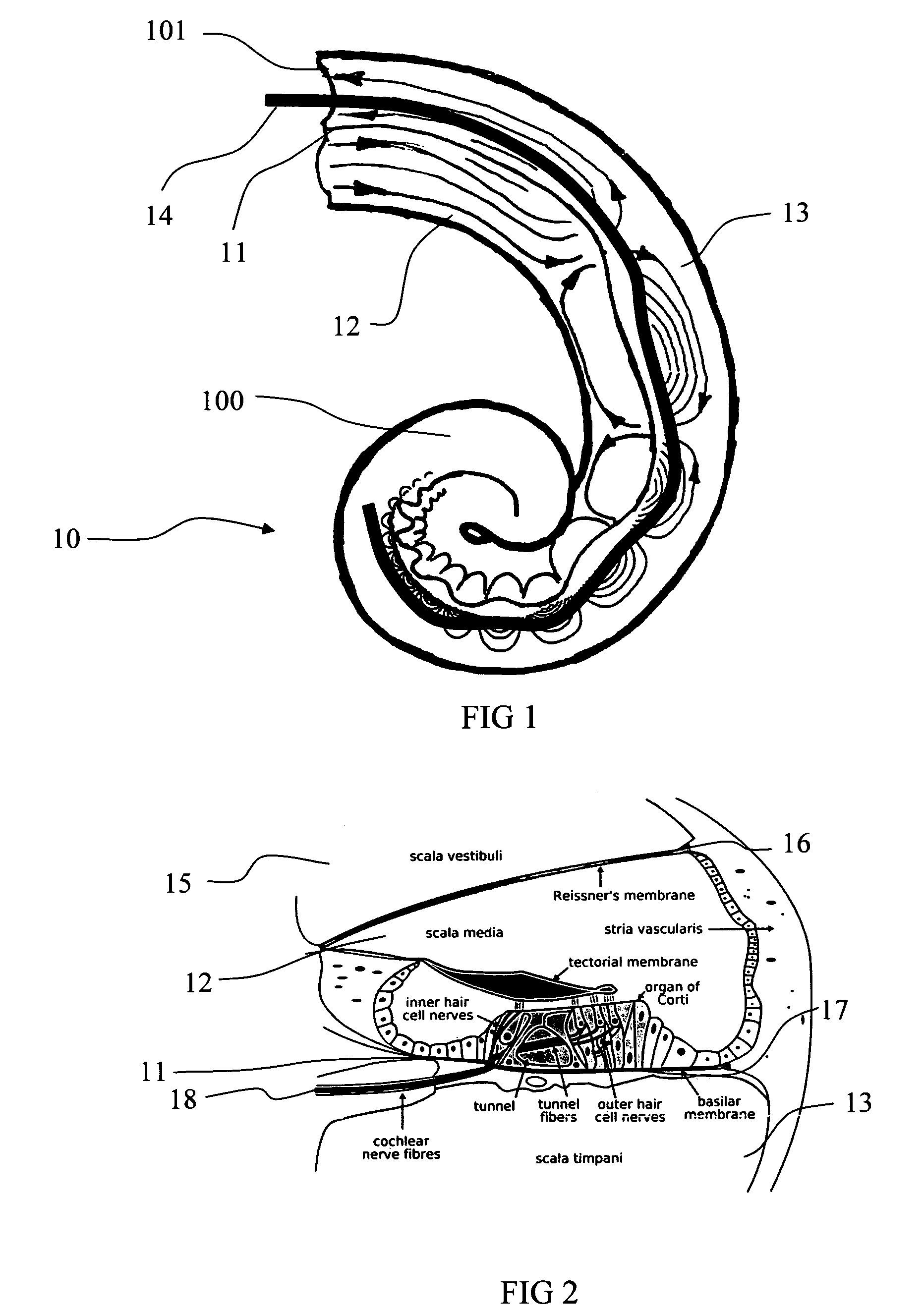 Cochlear implants