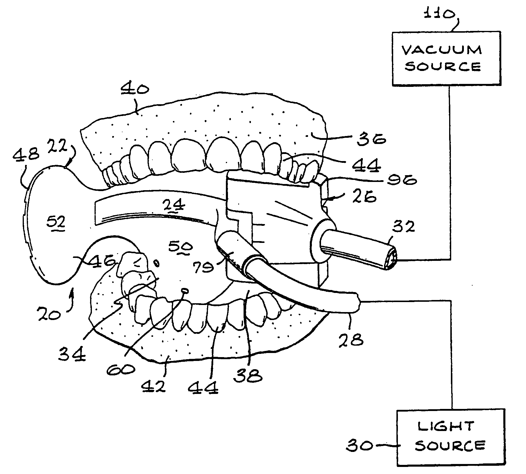 Intraoral device