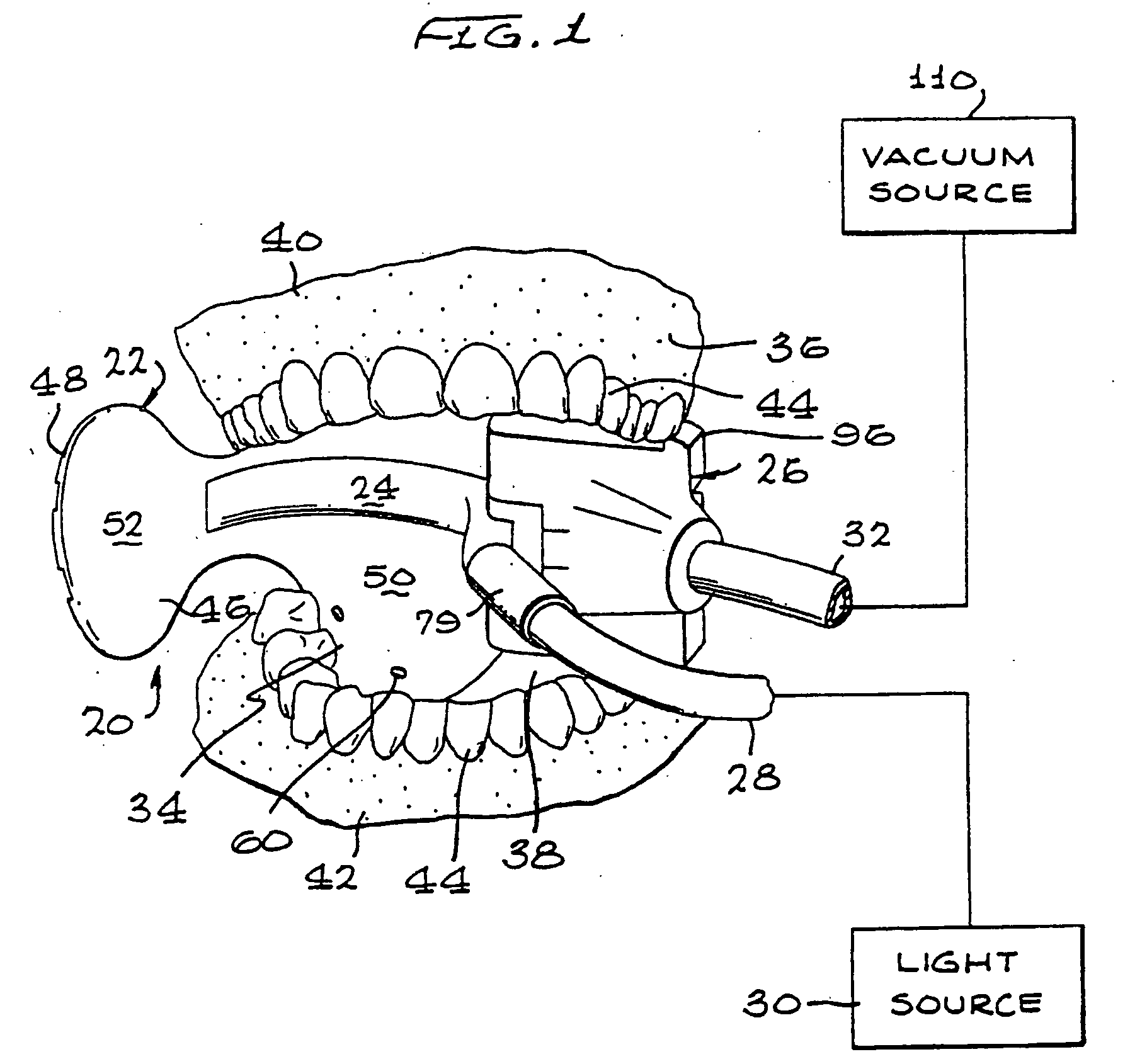 Intraoral device