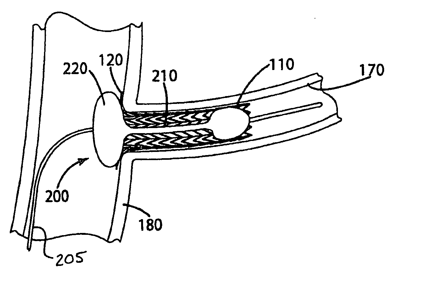 Ostial stent and balloon