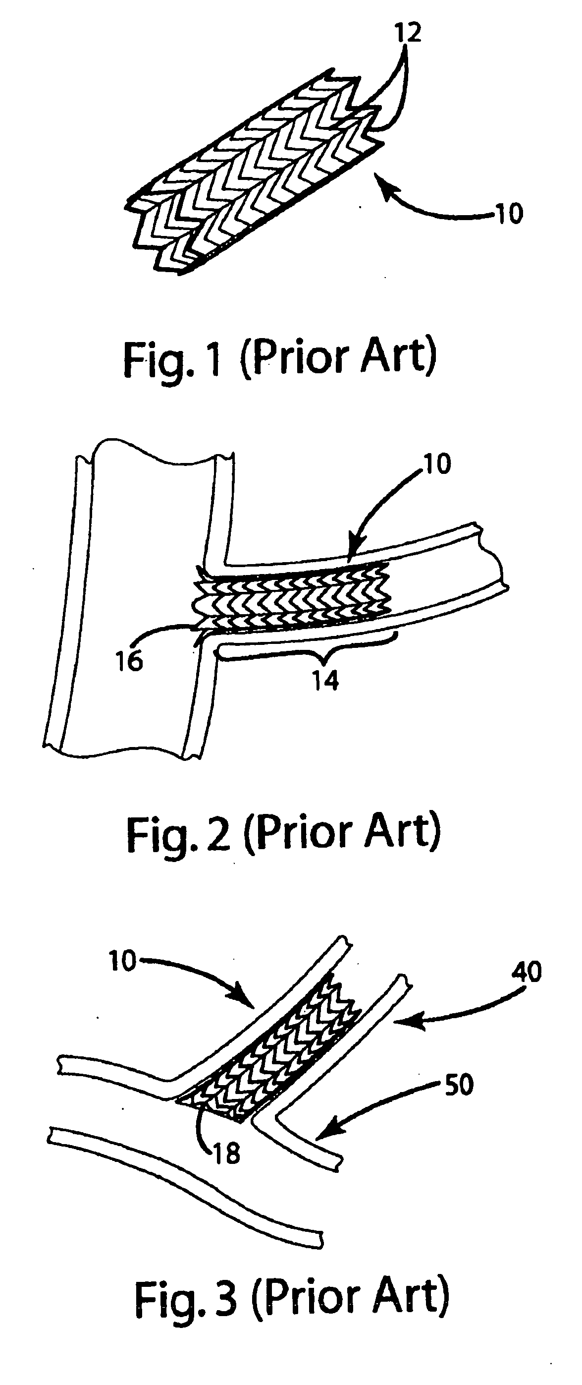 Ostial stent and balloon