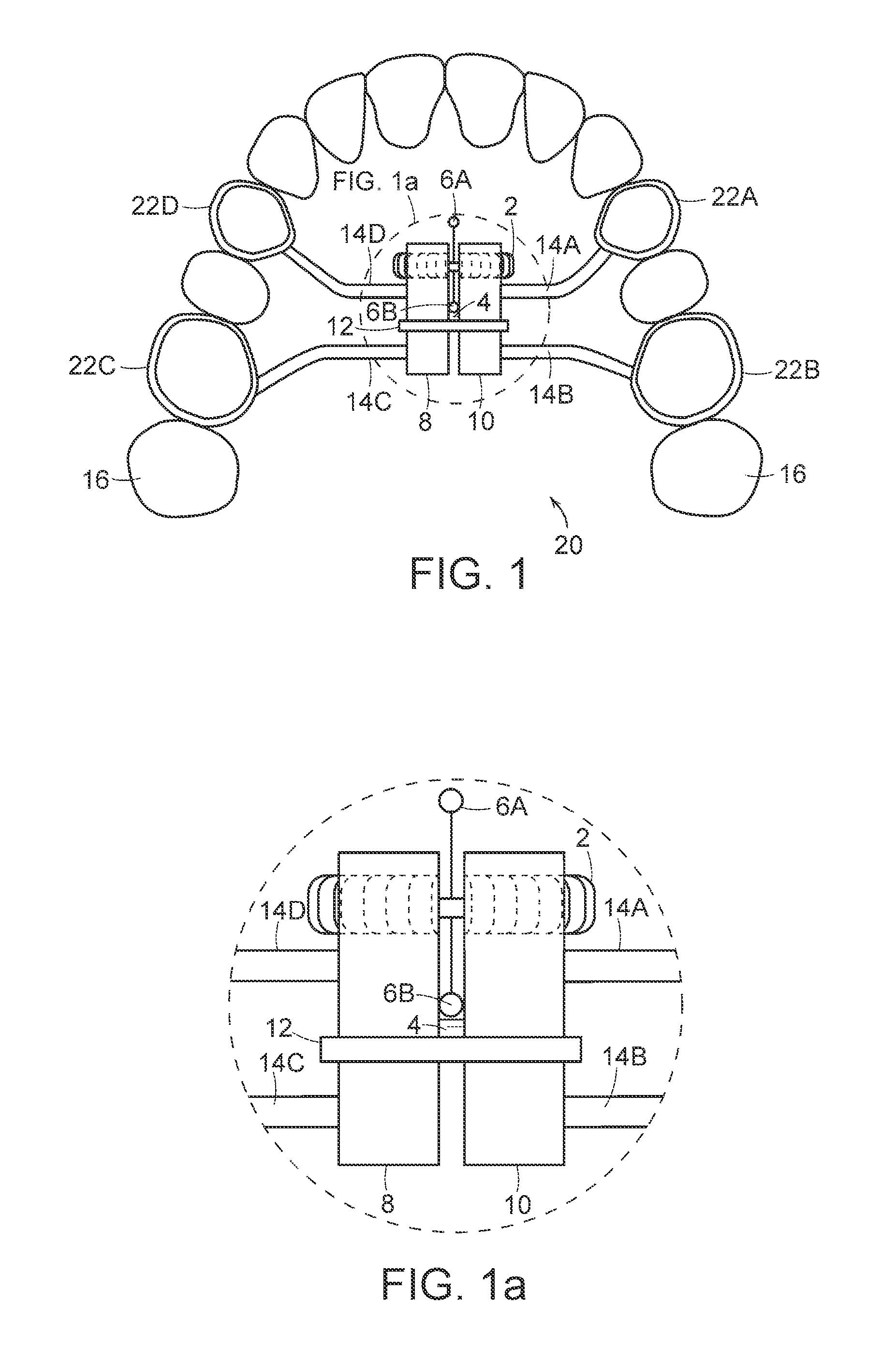 Palatal expansion device and methods