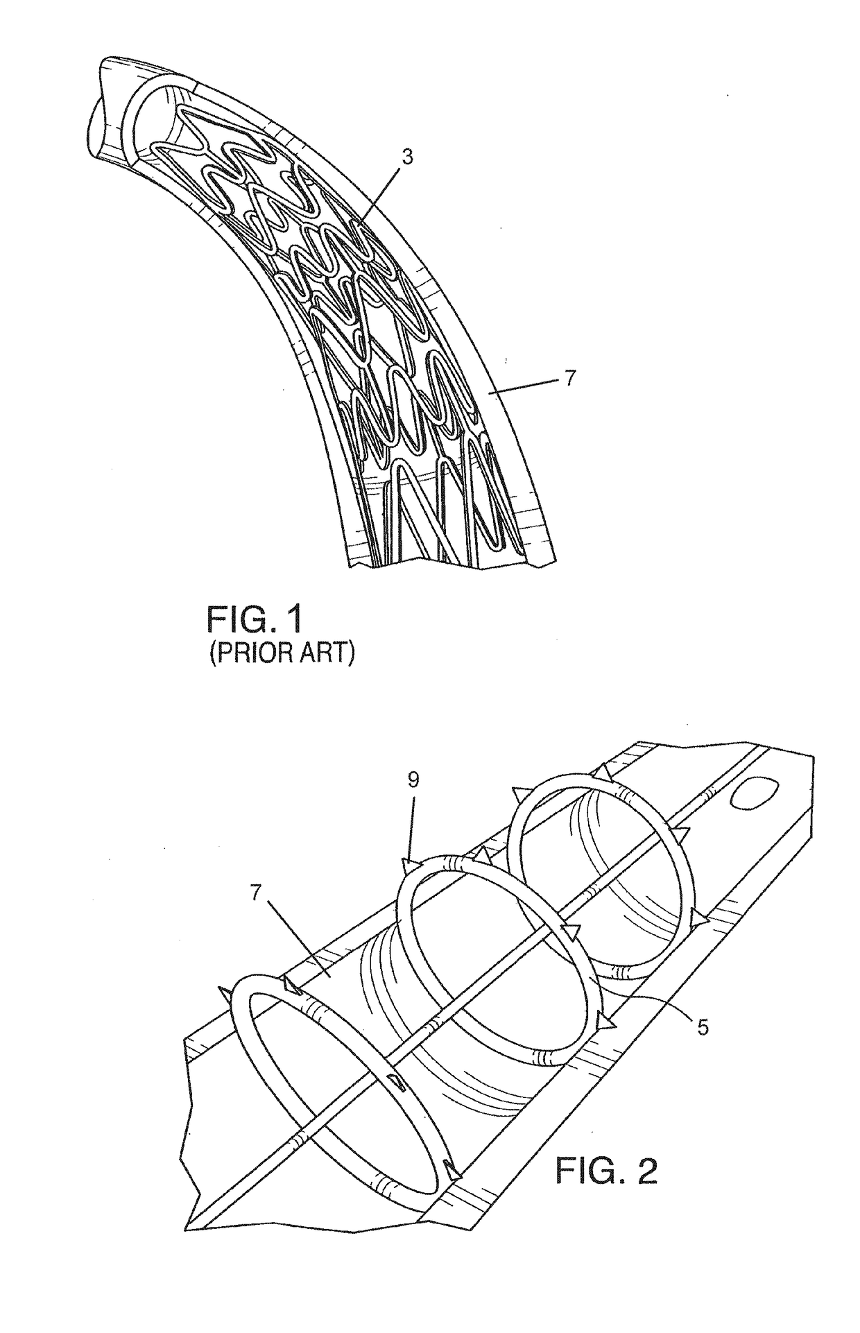 Endovascular implant