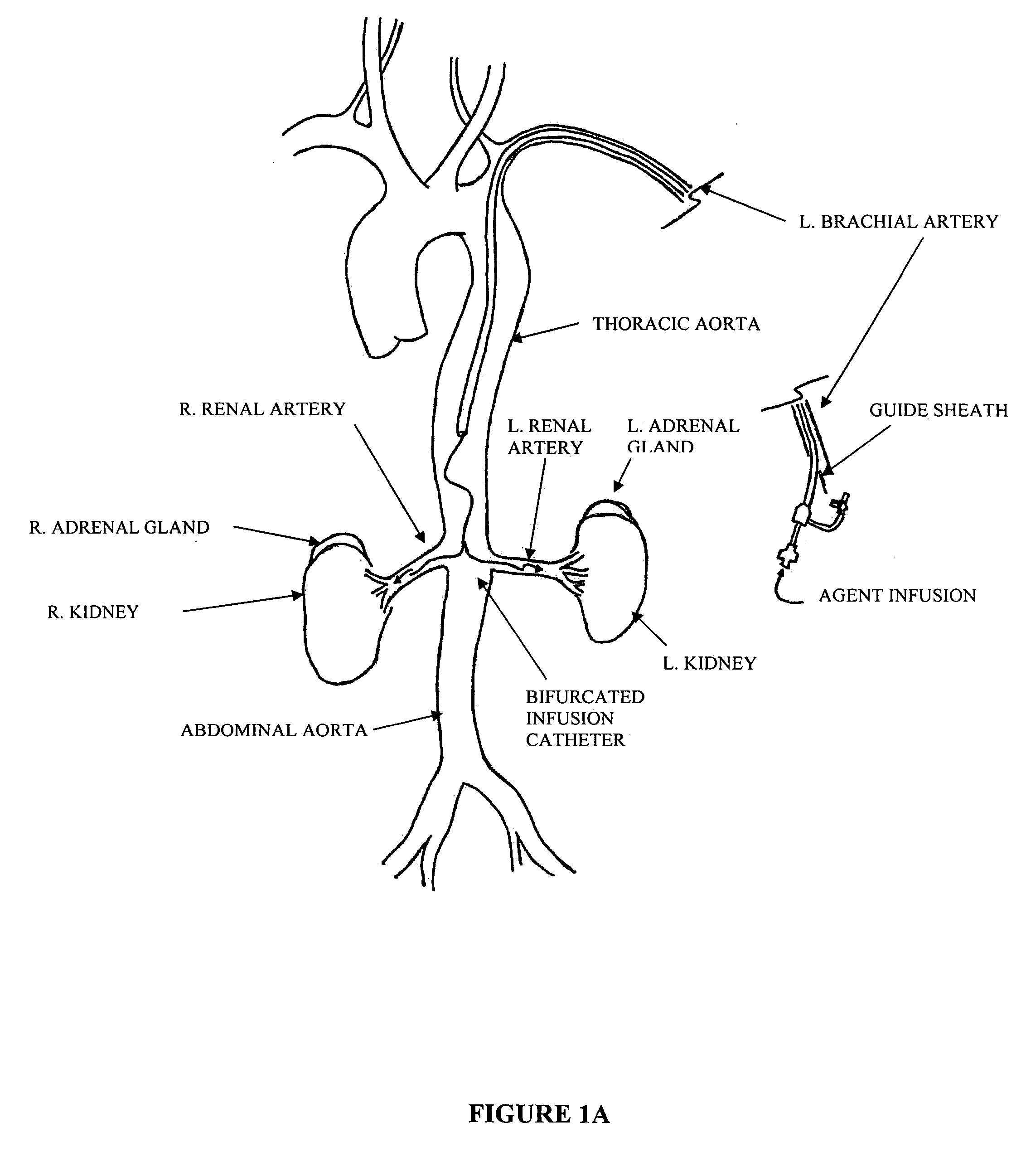 Bi-lateral local renal delivery for treating congestive heart failure and for BNP therapy