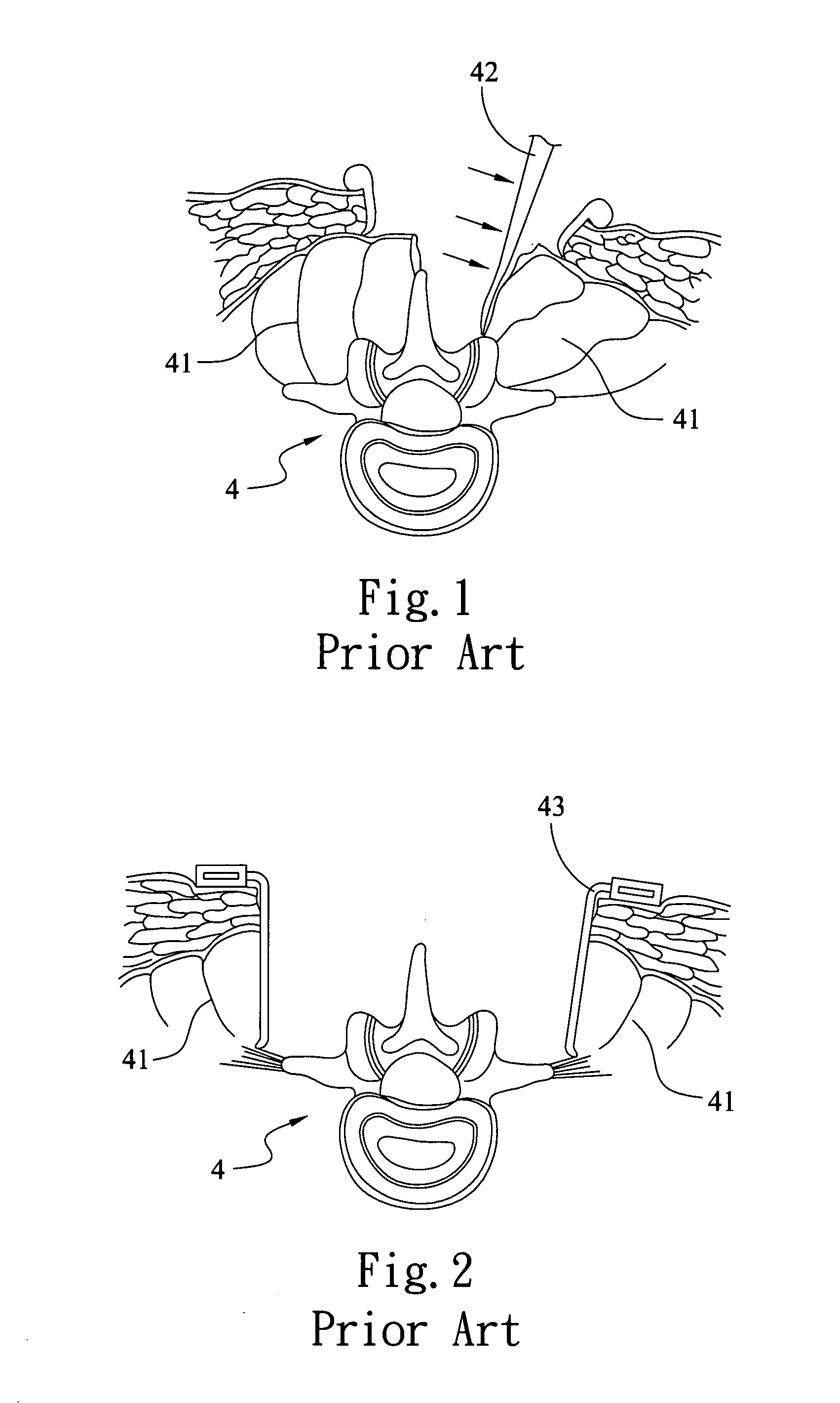 Expansion mechanism for minimally invasive lumbar operation