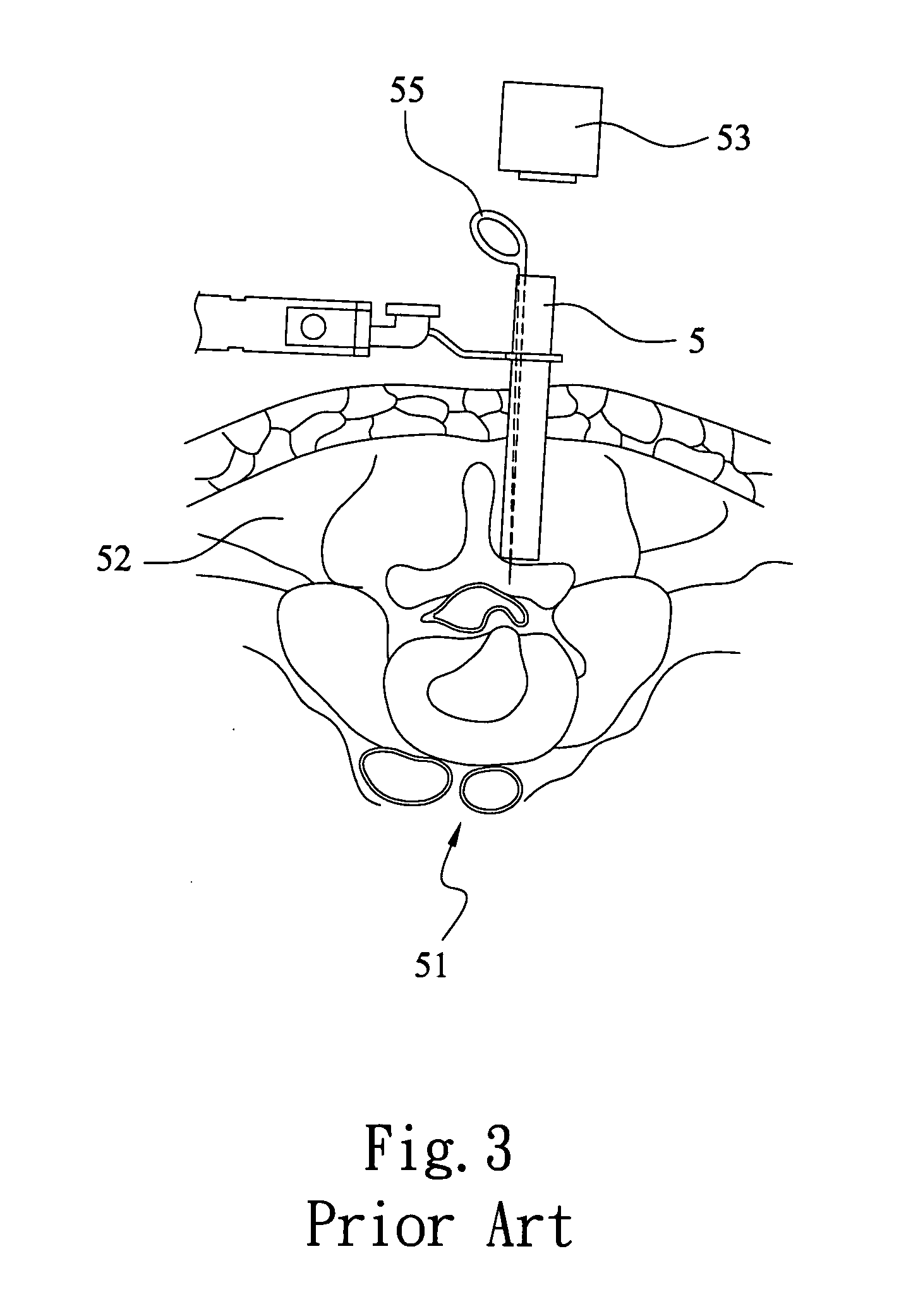 Expansion mechanism for minimally invasive lumbar operation