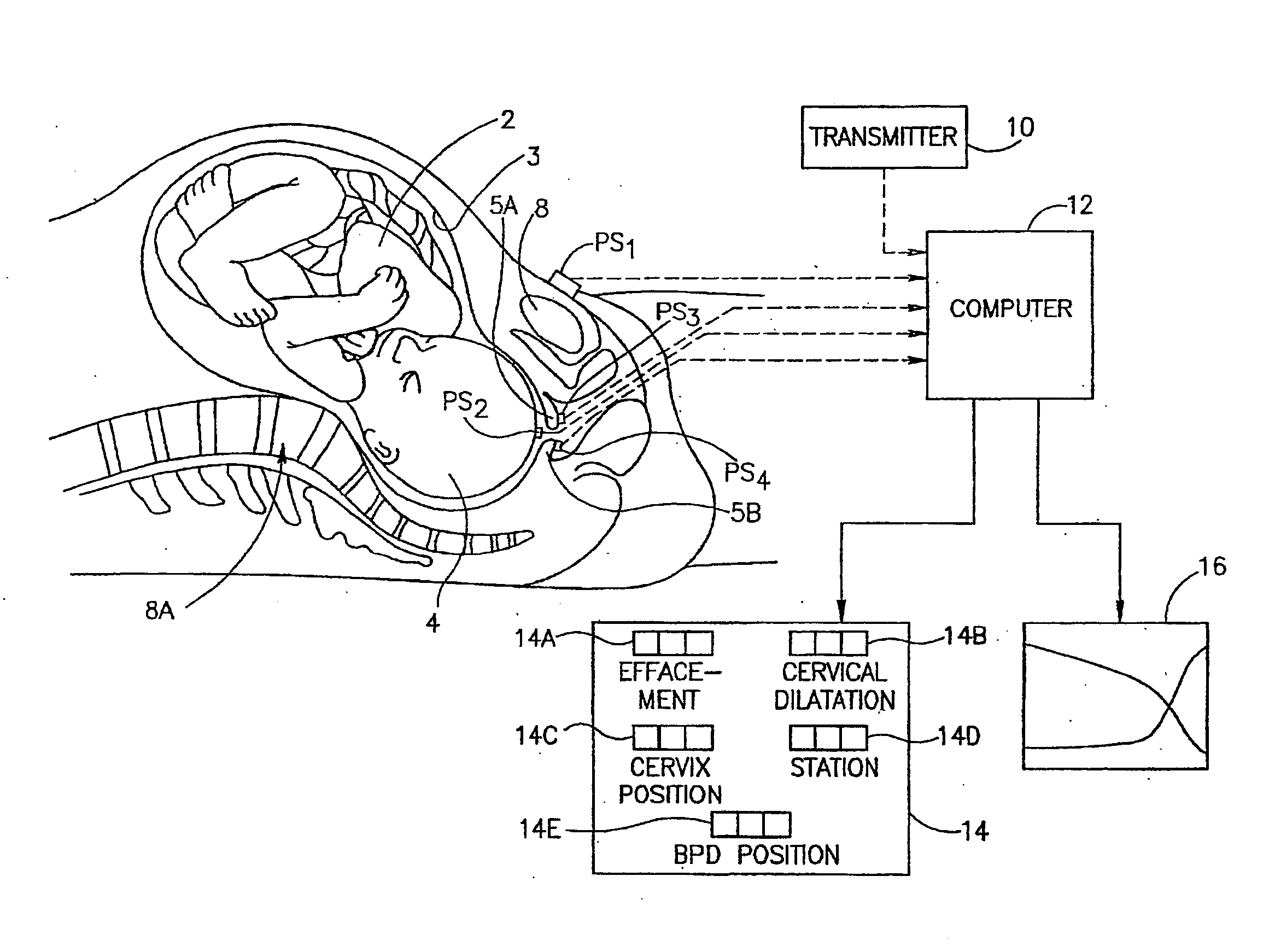 Method and Apparatus For Monitoring Labor Parameter