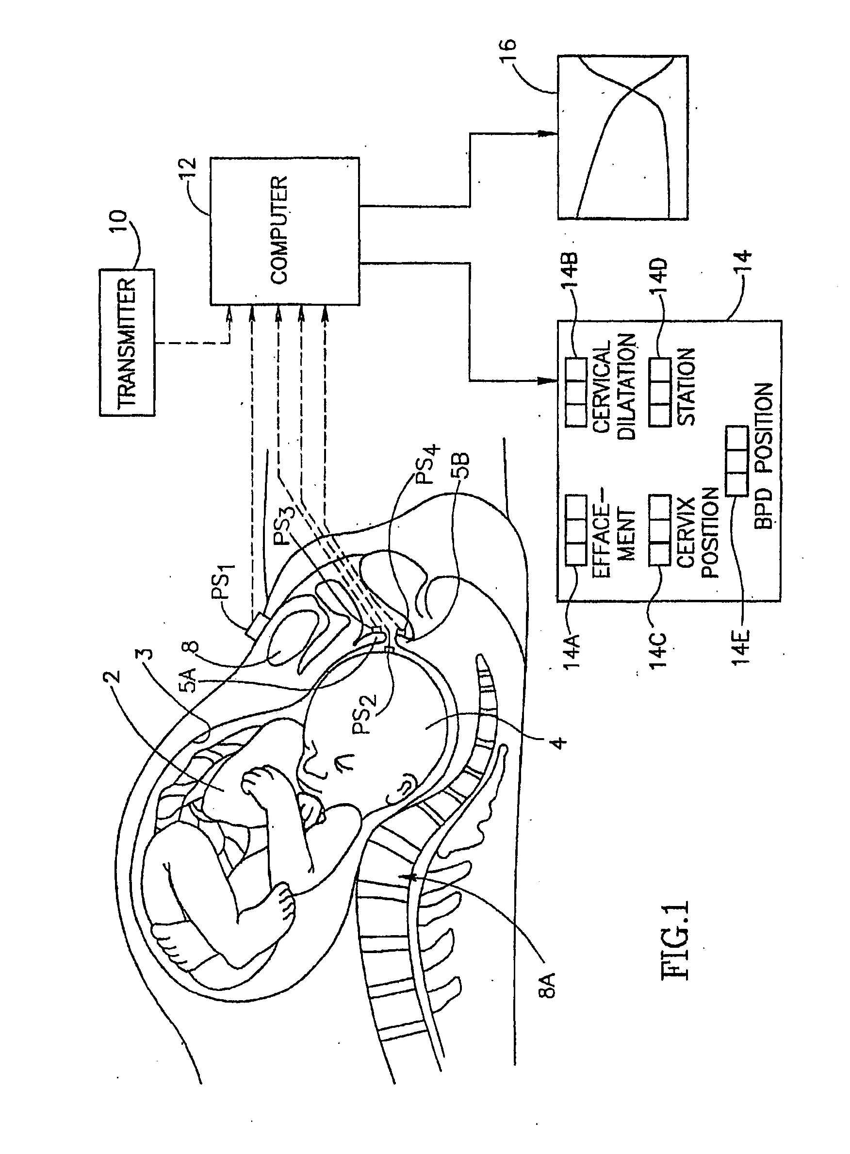 Method and Apparatus For Monitoring Labor Parameter