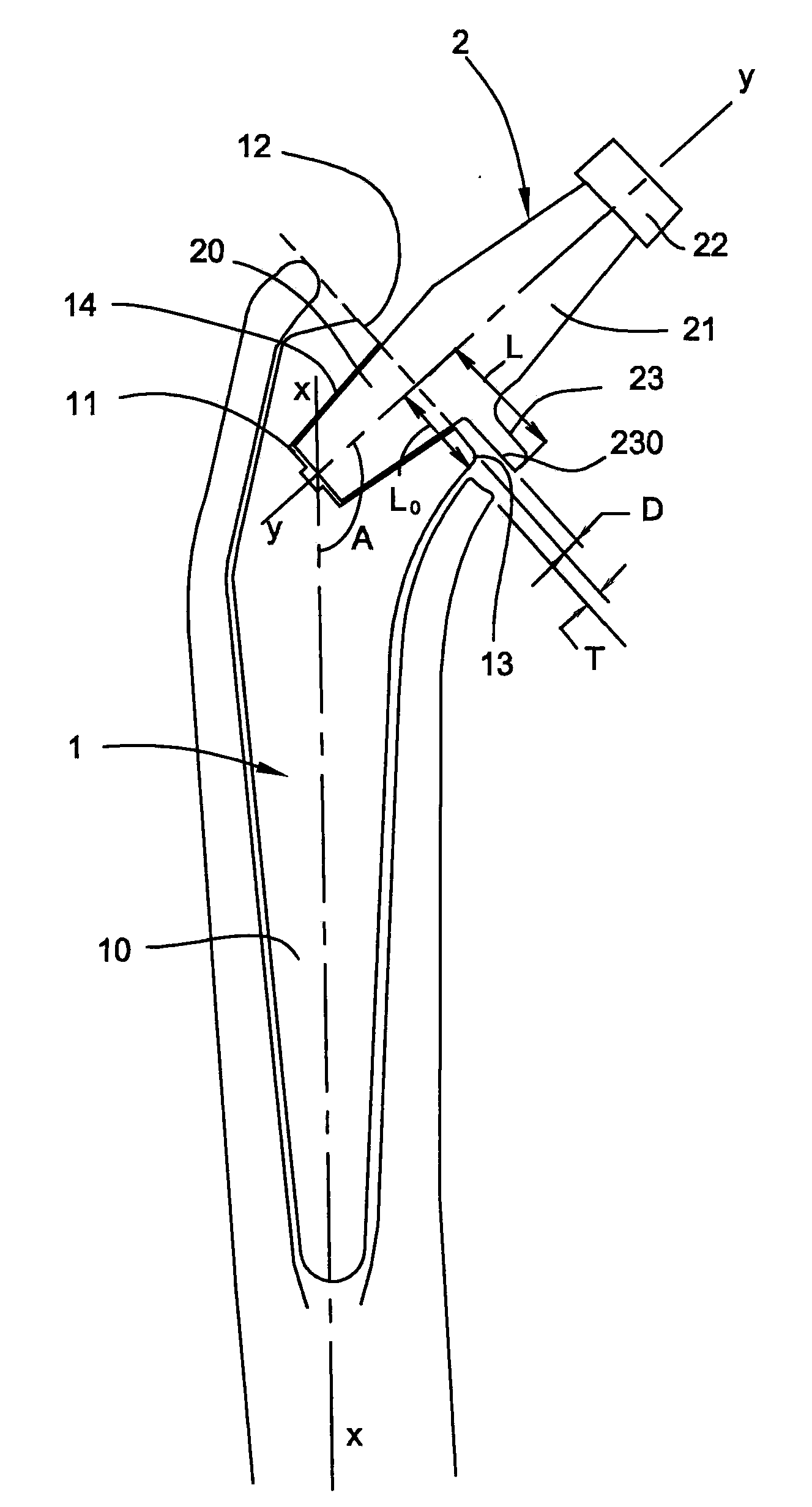 Elements of a femoral prosthesis with a modular neck, tooling for implanting a femoral prosthesis and method of implantation