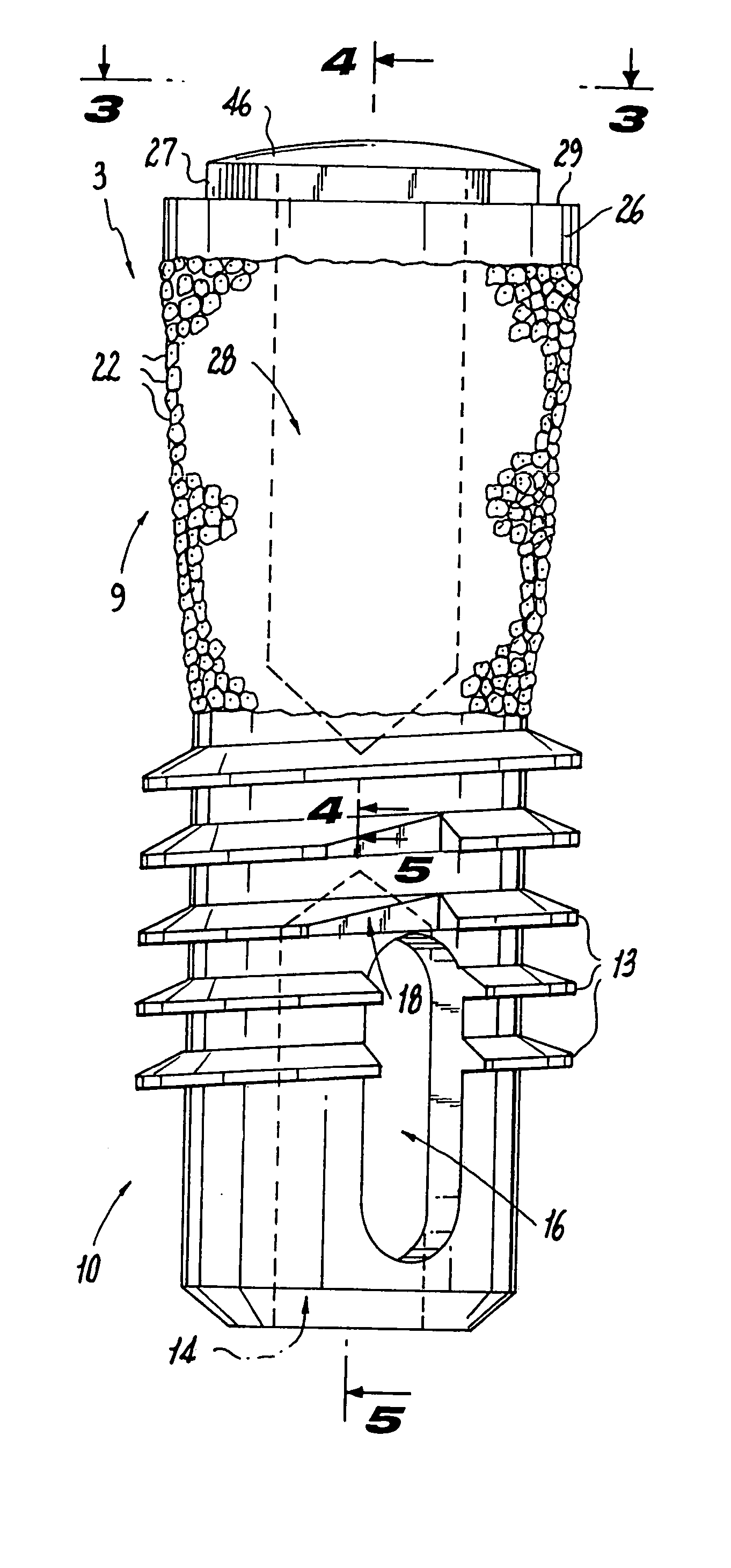 Immediate post-extraction implant