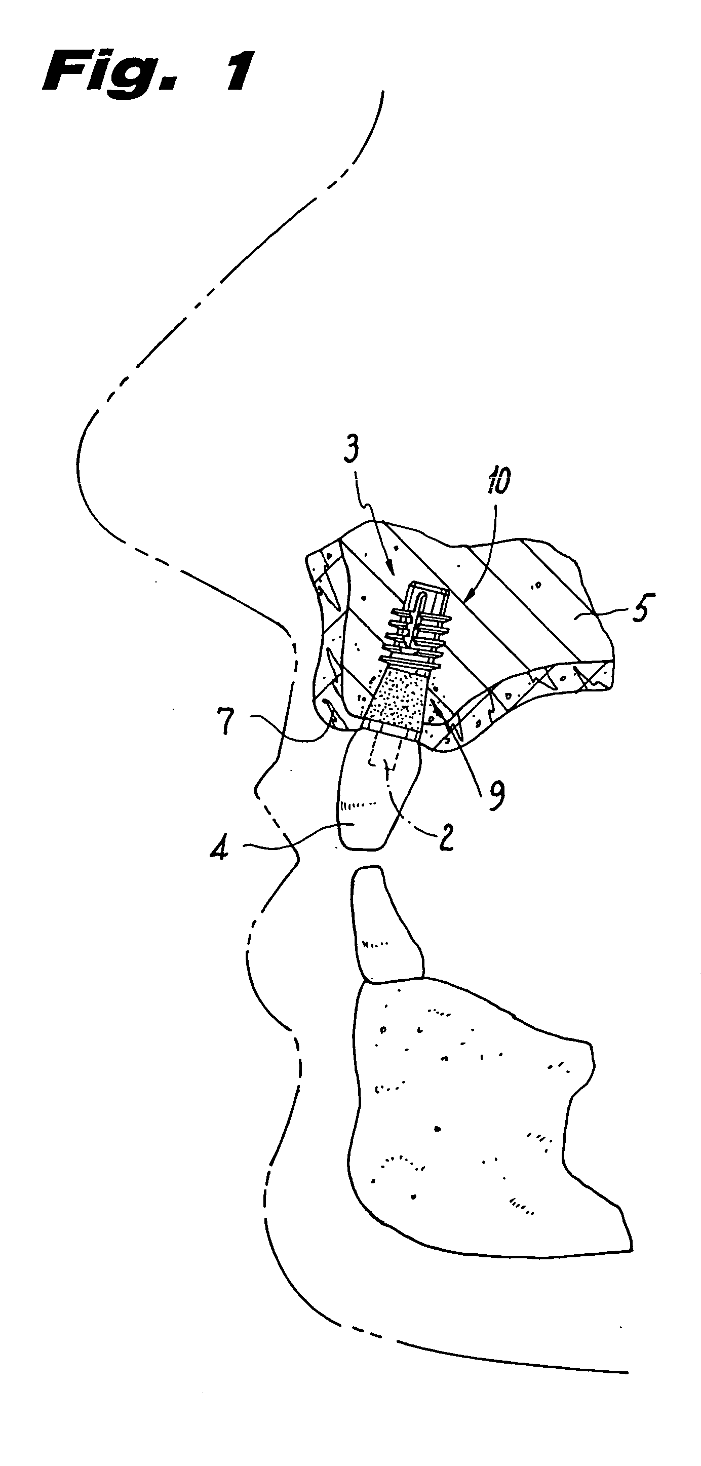 Immediate post-extraction implant