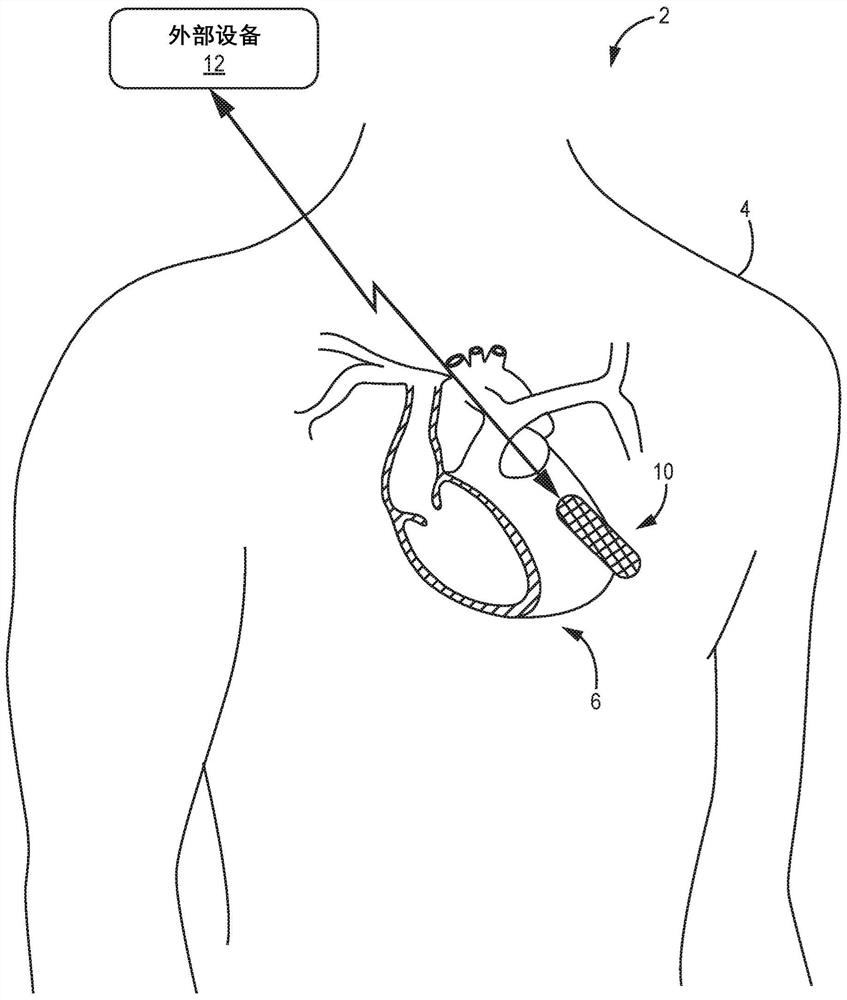 Sensing for heart failure management