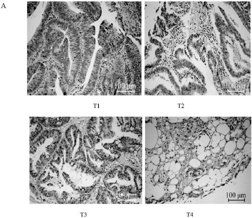 Application of ALDH18A1 in treatment and diagnosis of colorectal cancer