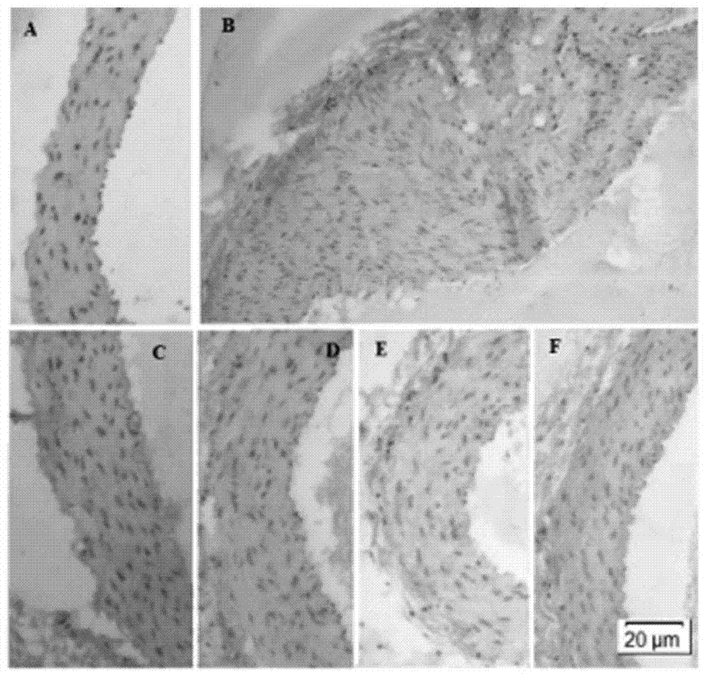 Application of rhodiola rosea oligomer procyanidine in preparing medicine for treating atherosclerosis disease