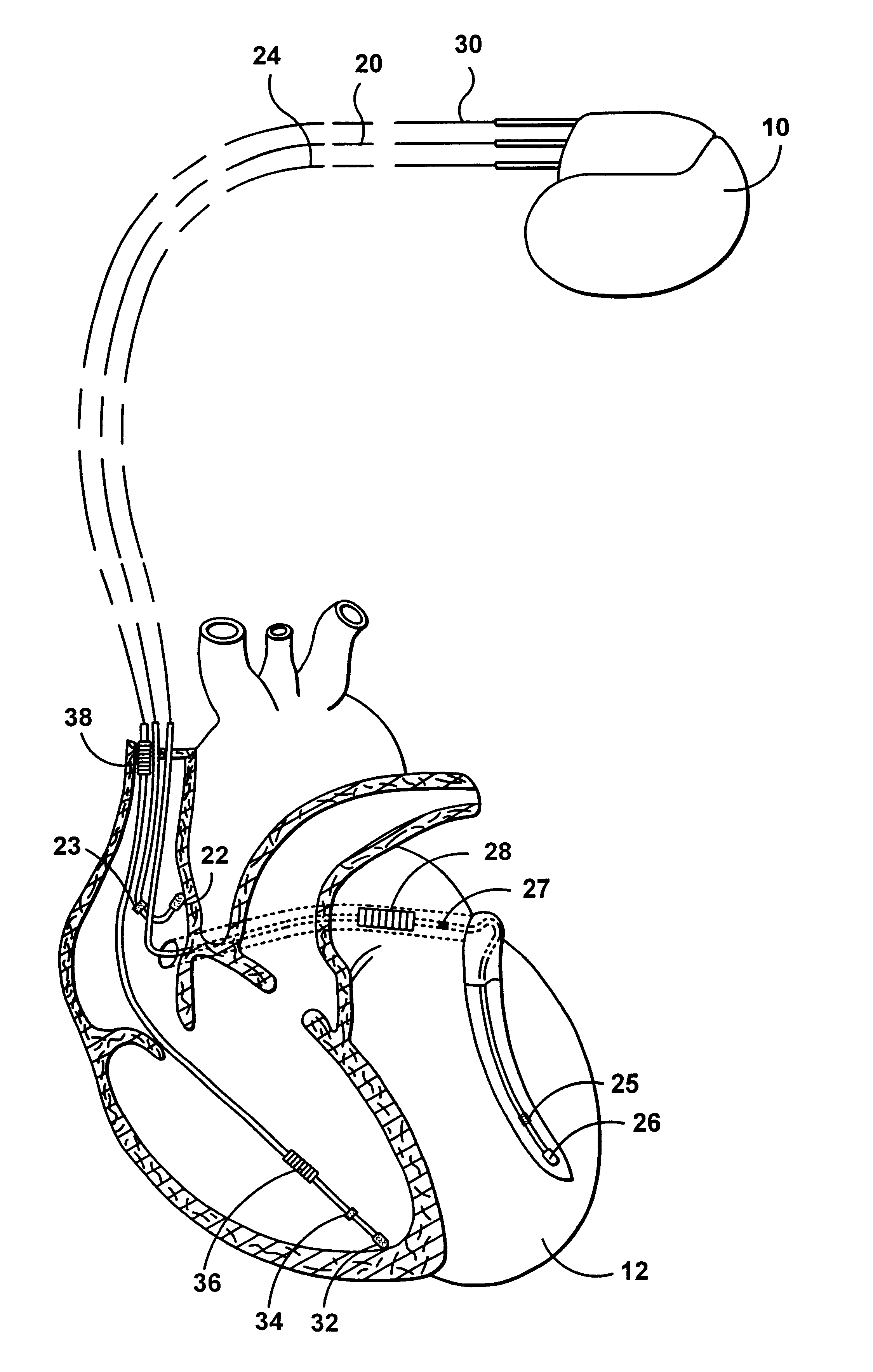 Multi-site cardiac stimulation device for controlling inter-chamber stimulation delay