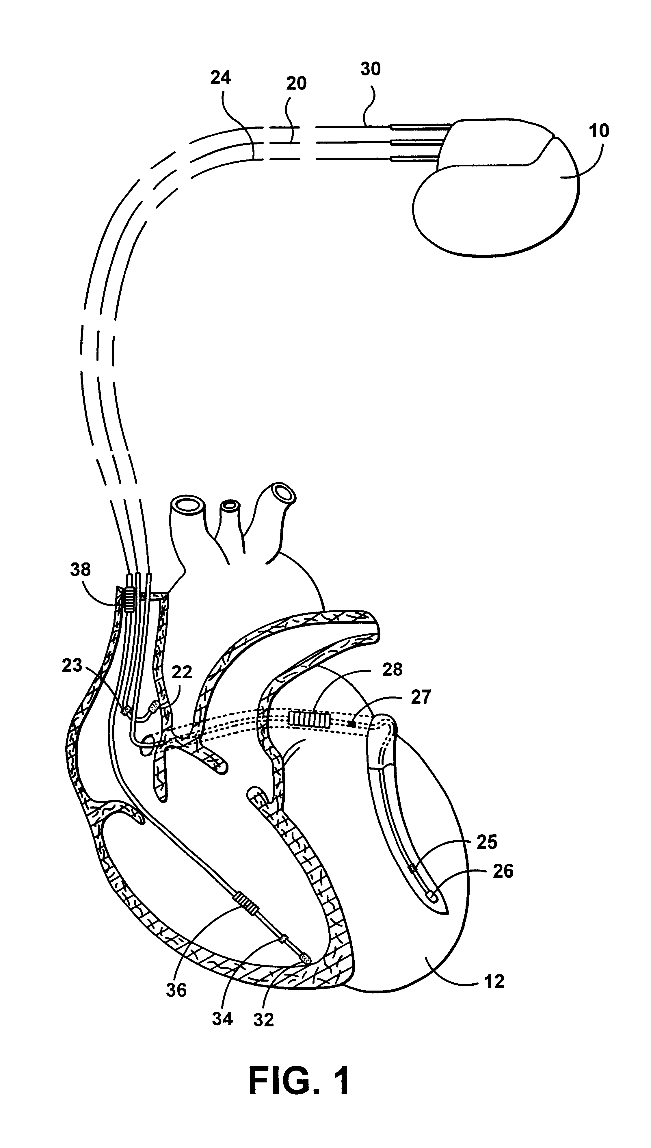 Multi-site cardiac stimulation device for controlling inter-chamber stimulation delay