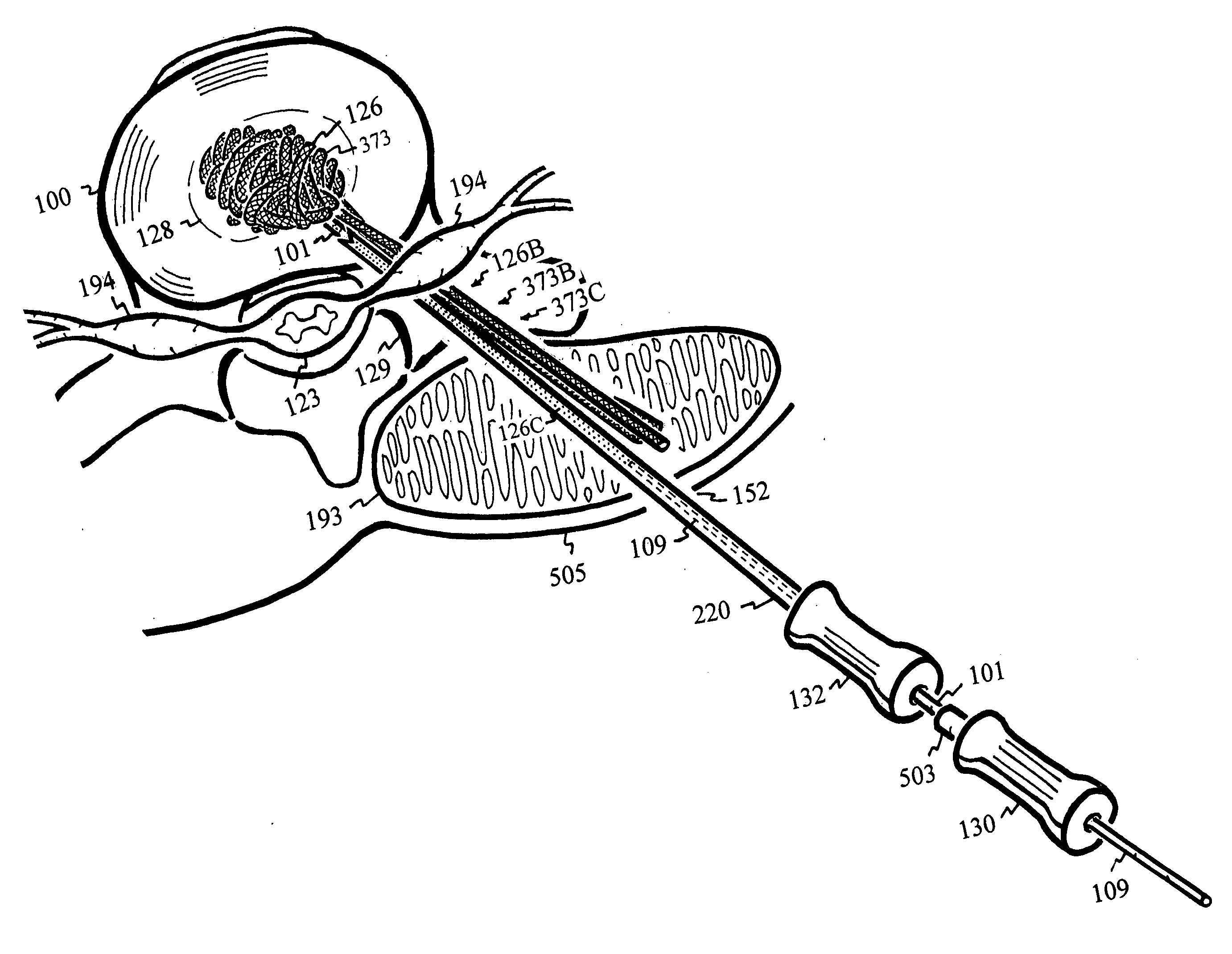 Internal and external disc shunts alleviate back pain