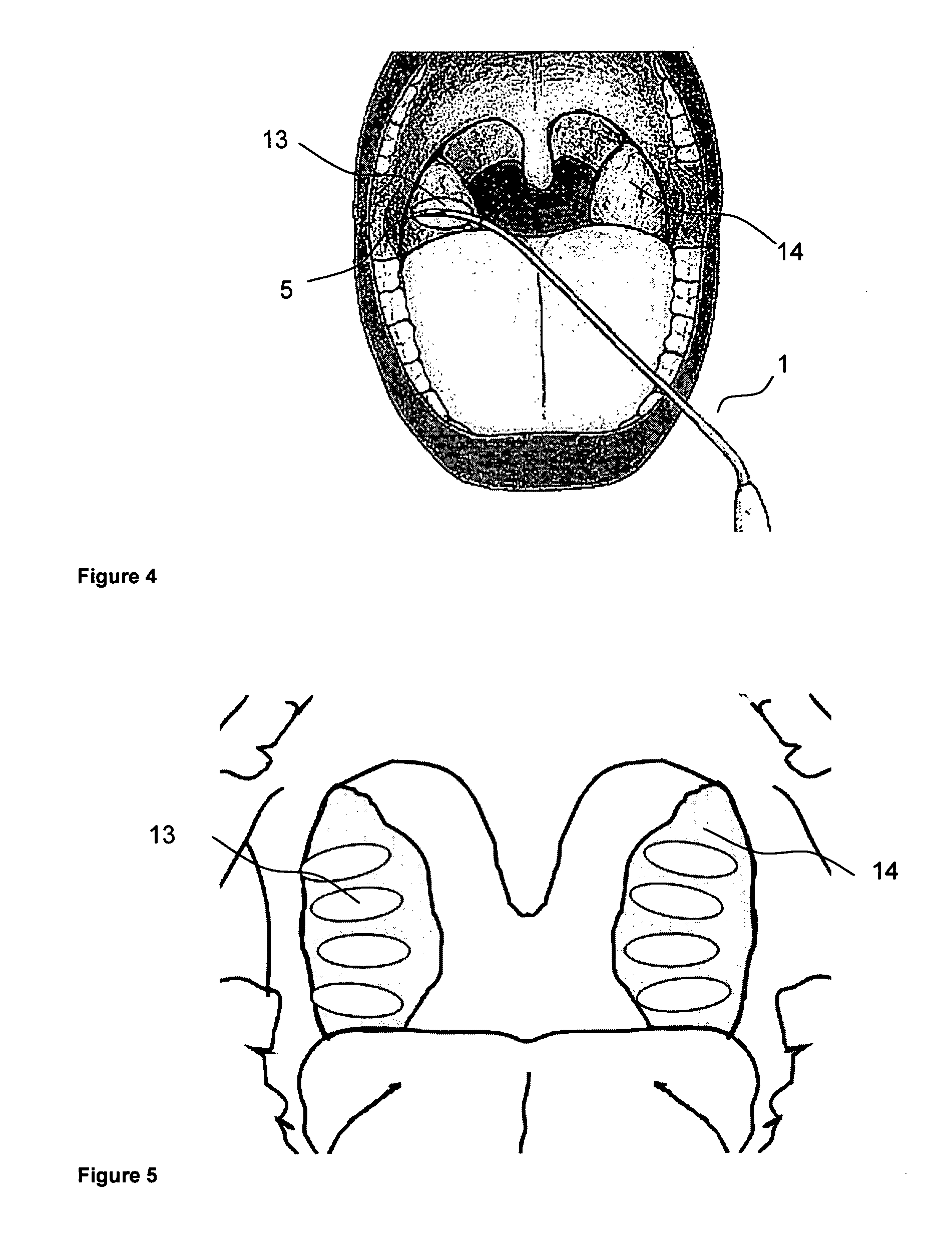 Method for treatment of hypertrophic palatine tonsils