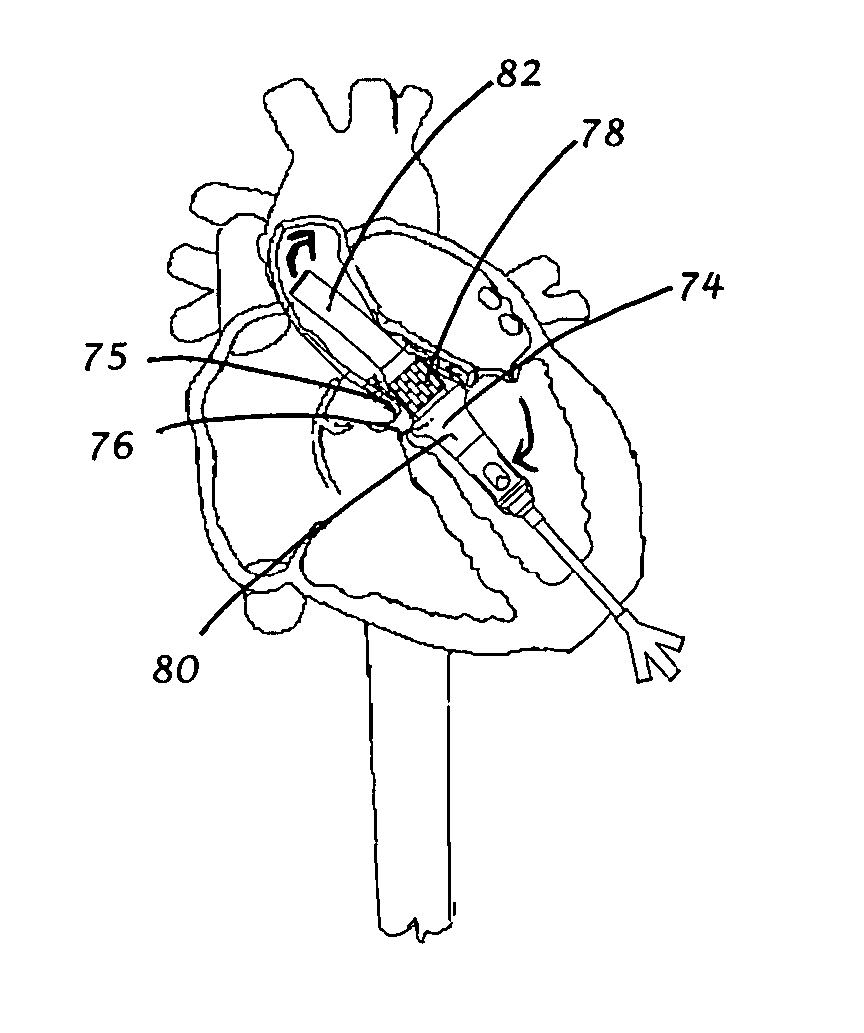 Cardiac support cannula device and method