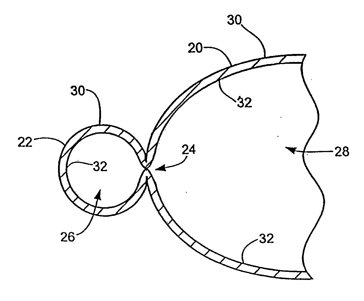 Obesity treatment tools and methods