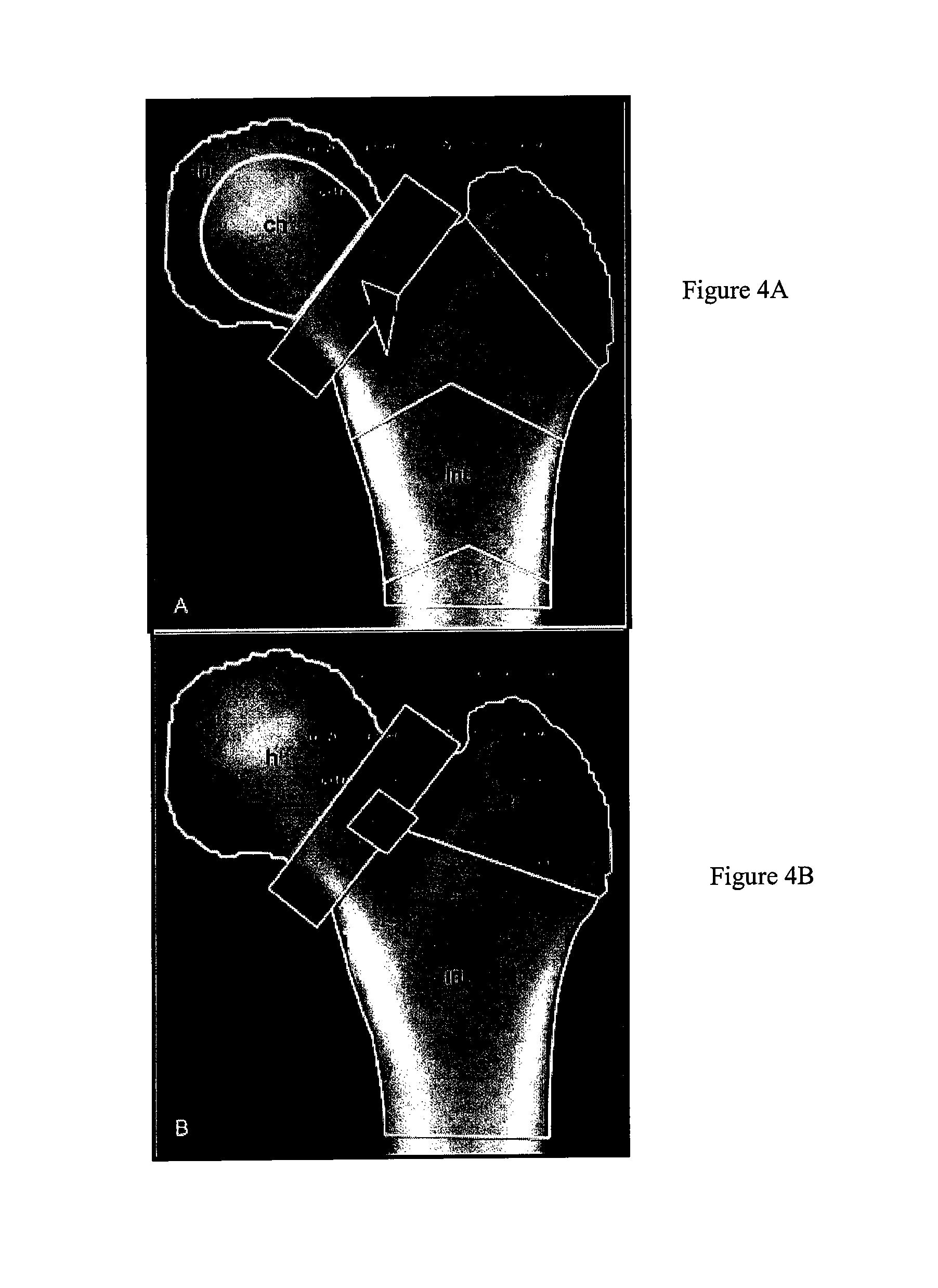 Templates for assessing bone quality and methods of use thereof