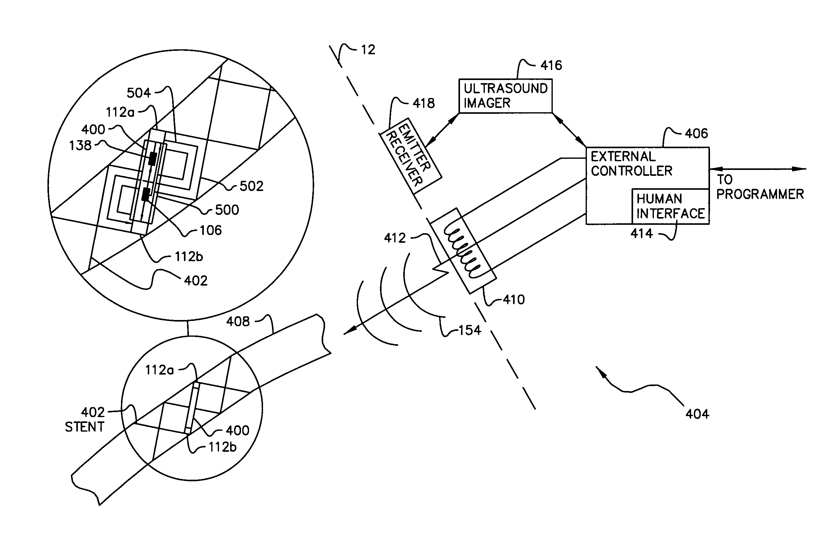 Stent having an ultrasonic emitter