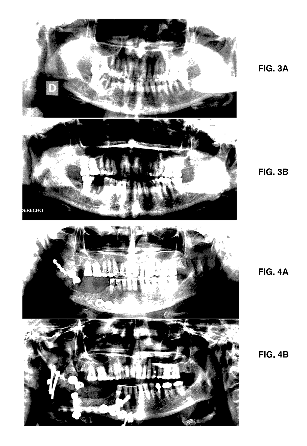 Formulation for regeneration of bone, cartilage, teeth, and periodontium and treatment of tumors and cysts