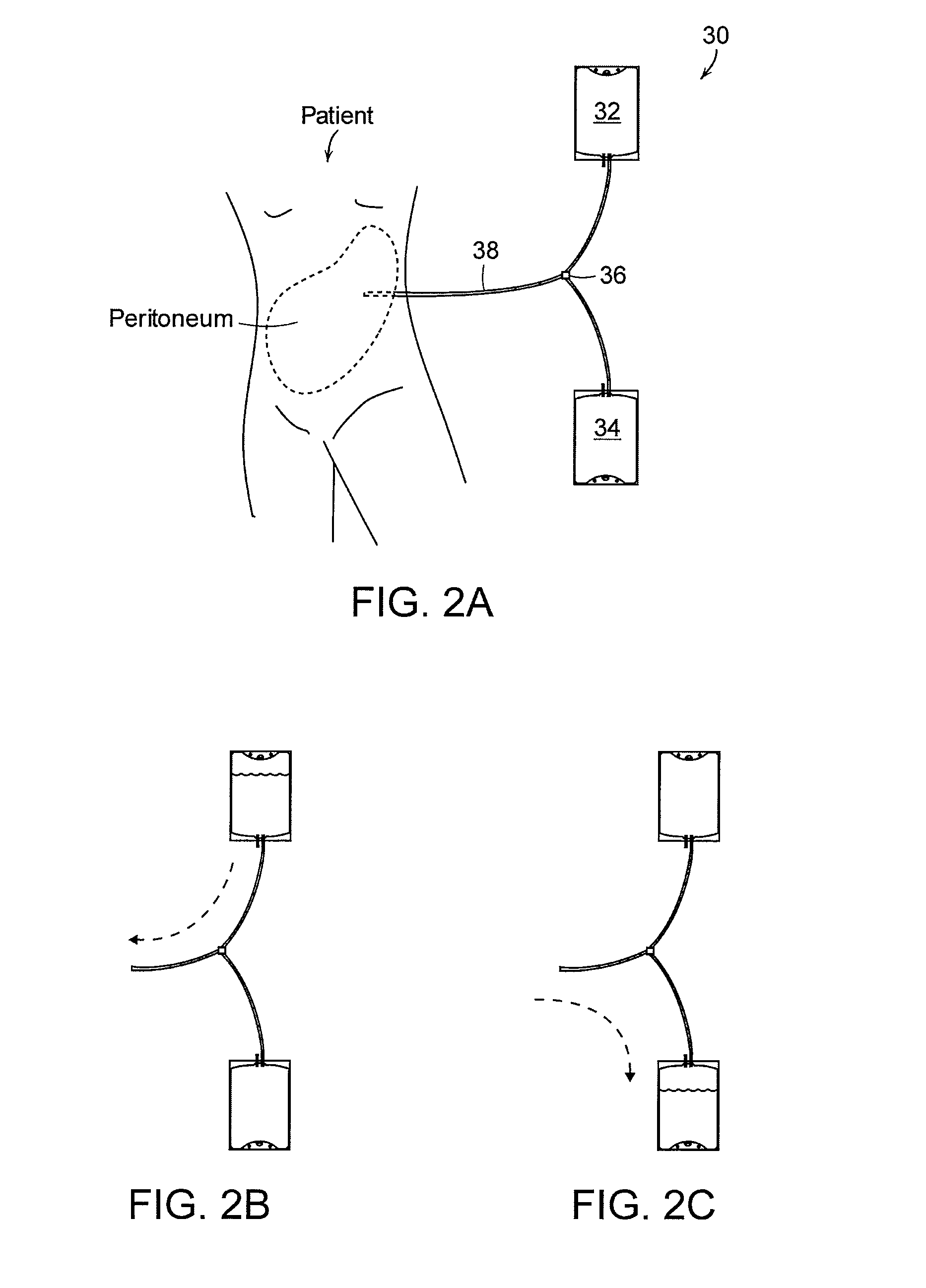 Apparatus and methods for early stage peritonitis detection and for in vivo testing of bodily fluid