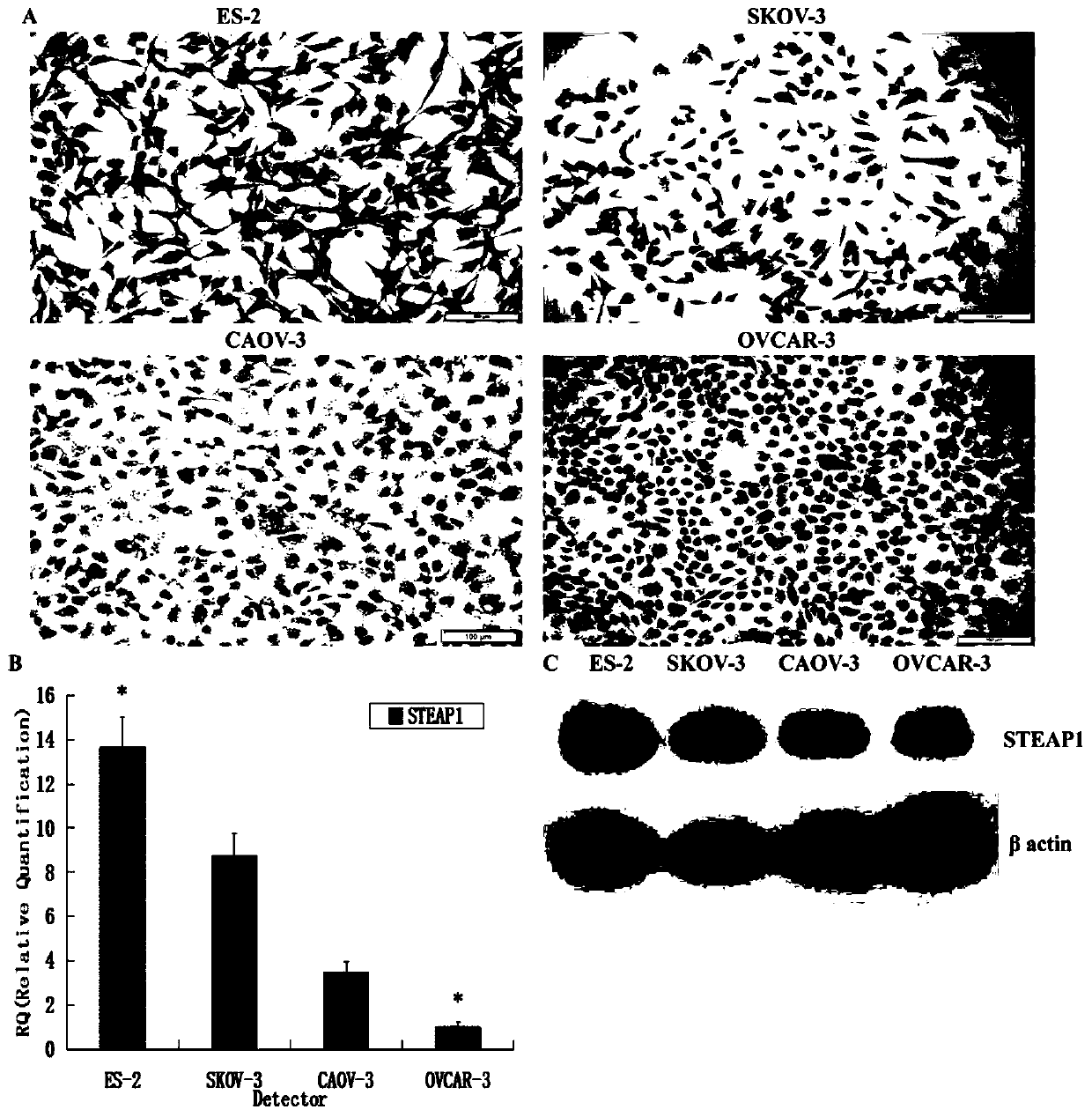 Application of STEAP1 in diagnosis, treatment and prognosis of ovarian cancer