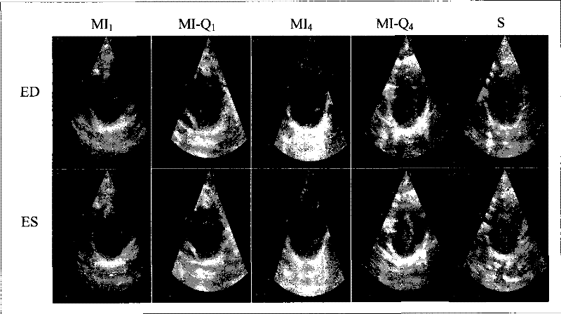 Use of traditional Chinese medicine in preparing medicine for treating myocardial infarction