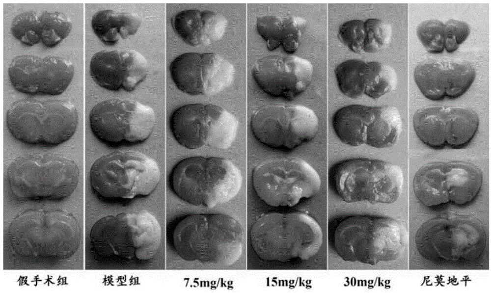 Application of Matrine in preparation of medicine for treating cerebral arterial thrombosis