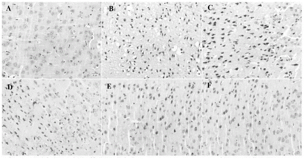 Application of Matrine in preparation of medicine for treating cerebral arterial thrombosis