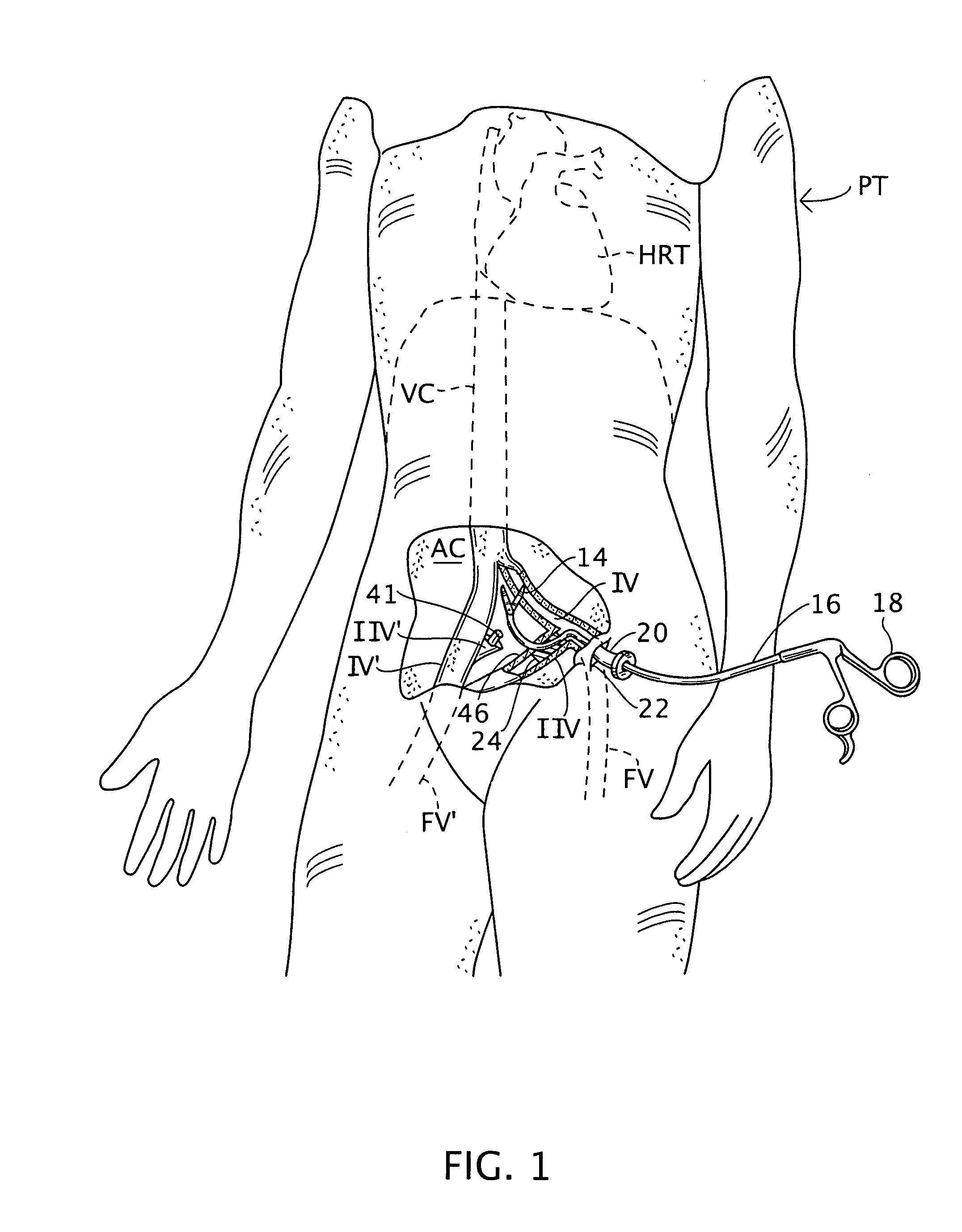 Trans-vascular surgical method and associated device